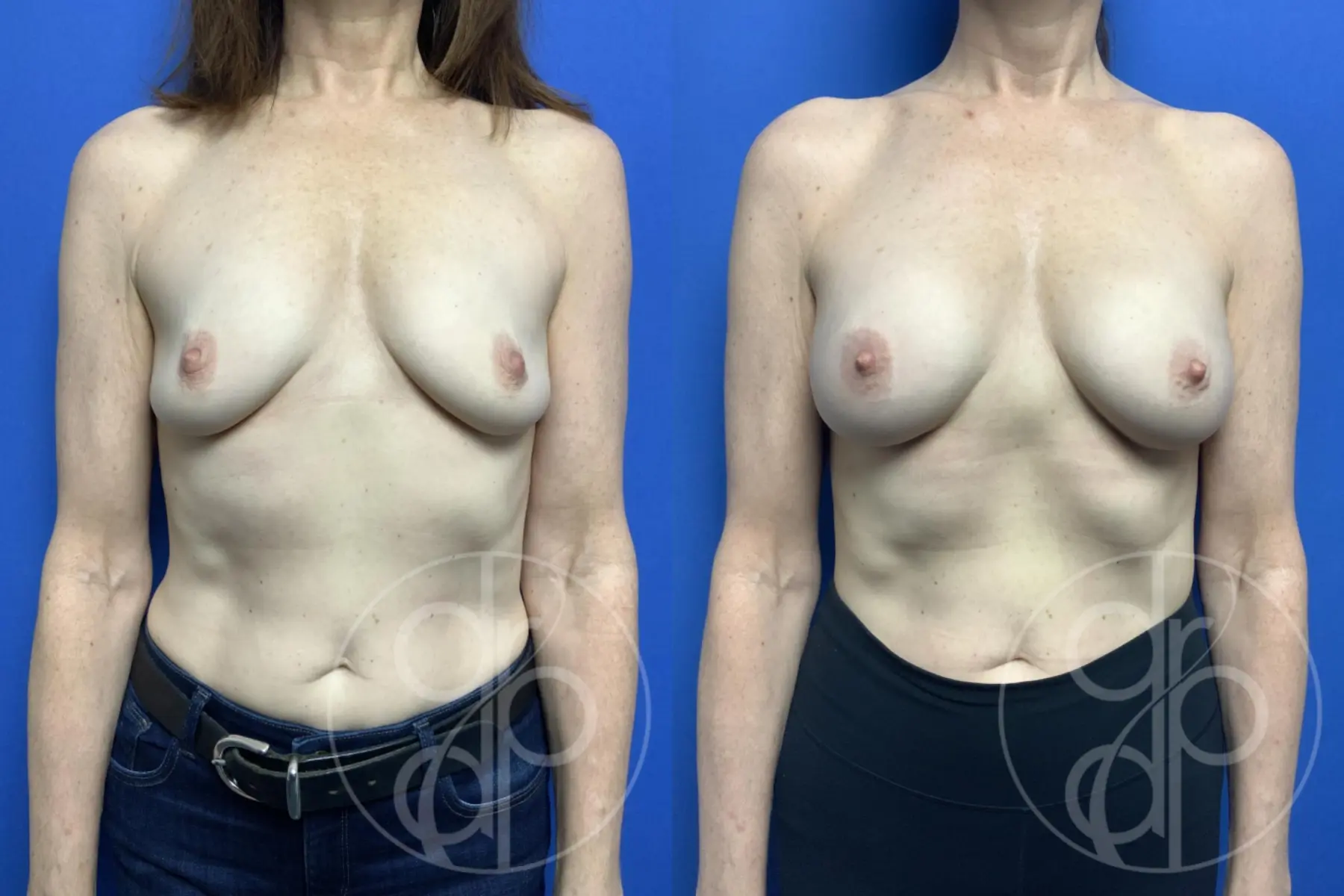 patient 11959 breast augmentation before and after result - Before and After 1