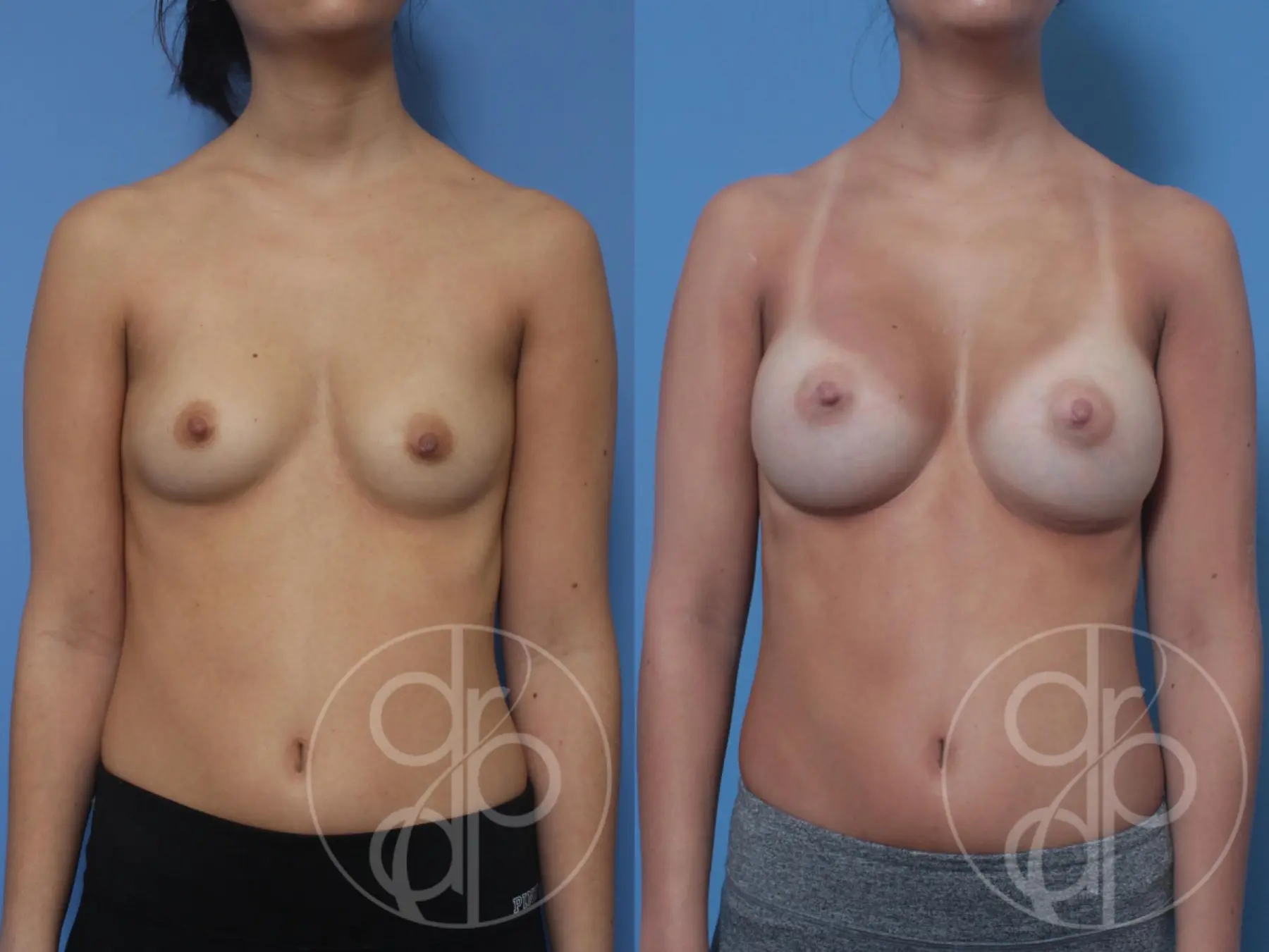 patient 10303 breast augmentation before and after result - Before and After