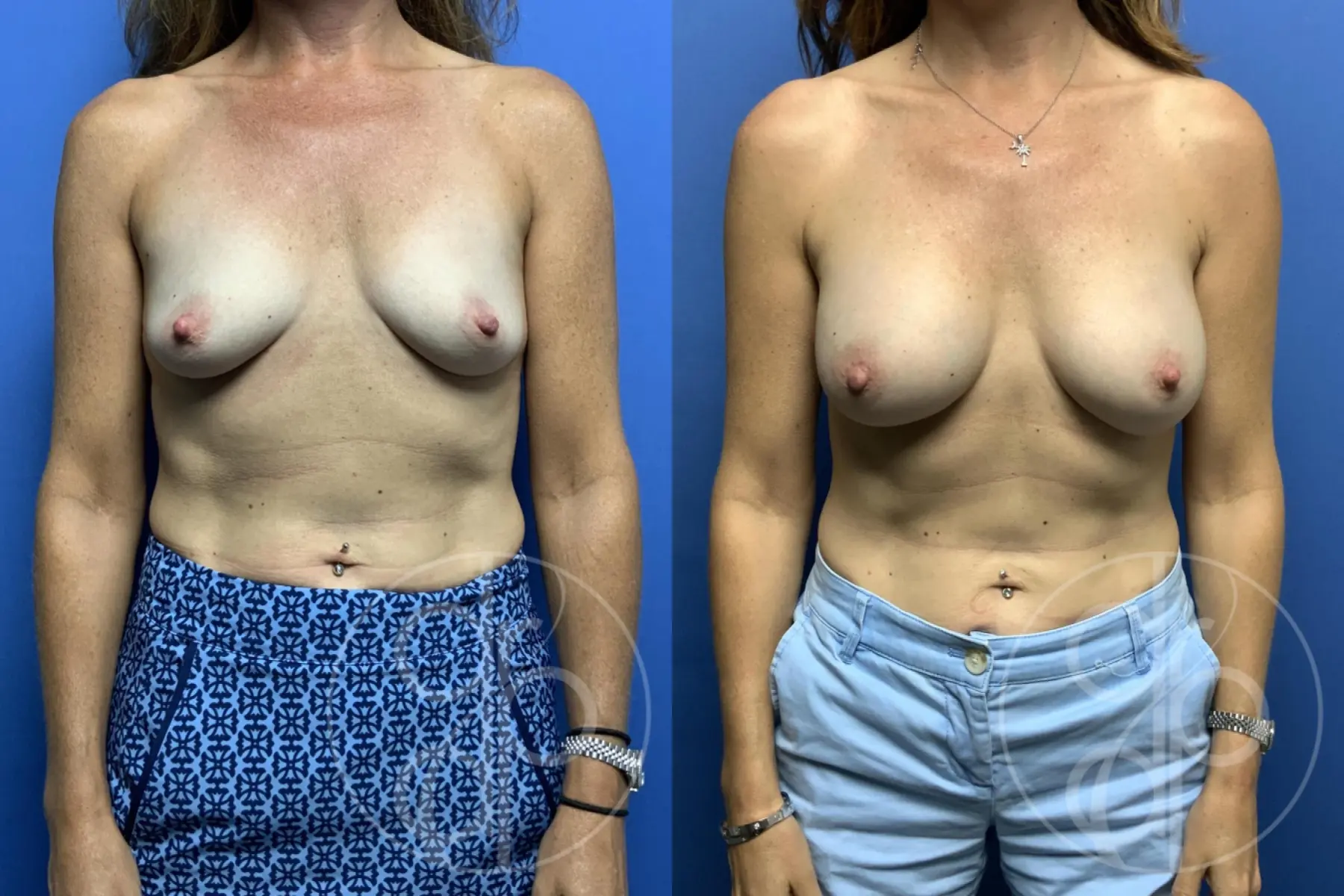 patient 12496 breast augmentation before and after result - Before and After