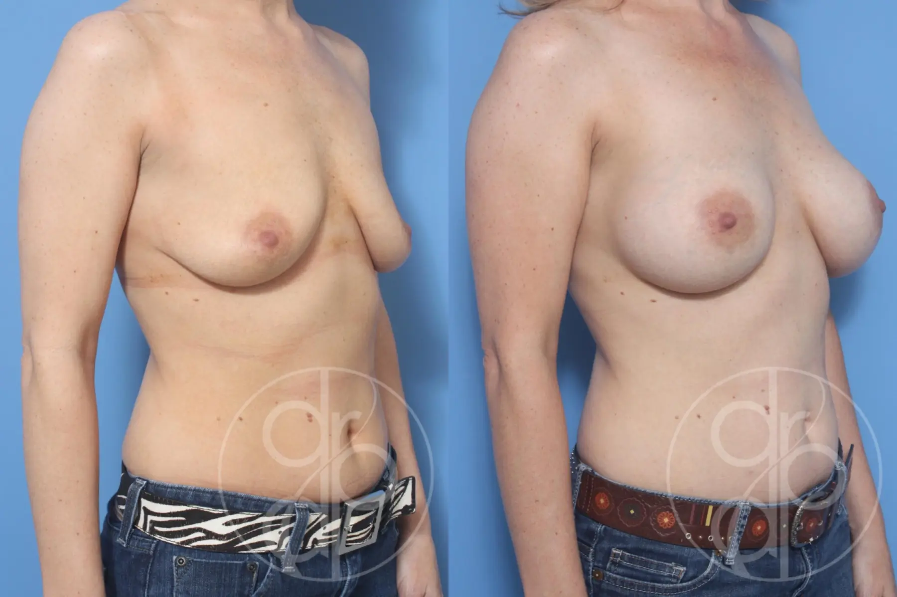 patient 12899 breast augmentation before and after result - Before and After 2