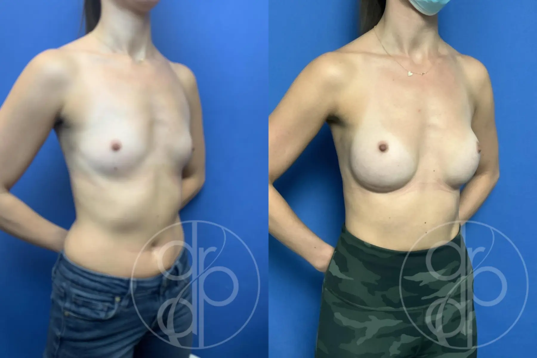 patient 10787 breast augmentation before and after result - Before and After 2