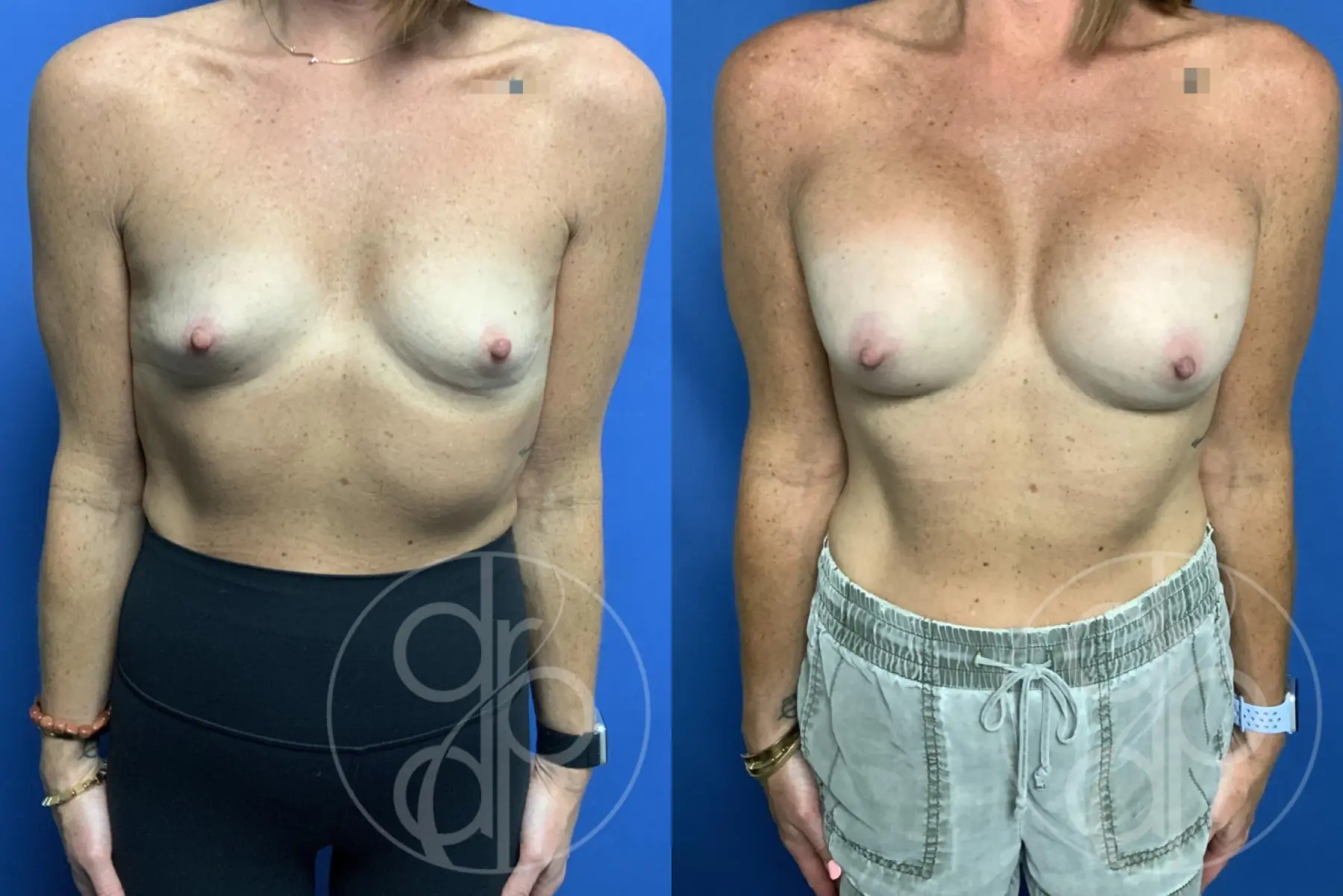 patient 13396 breast augmentation before and after result - Before and After 1