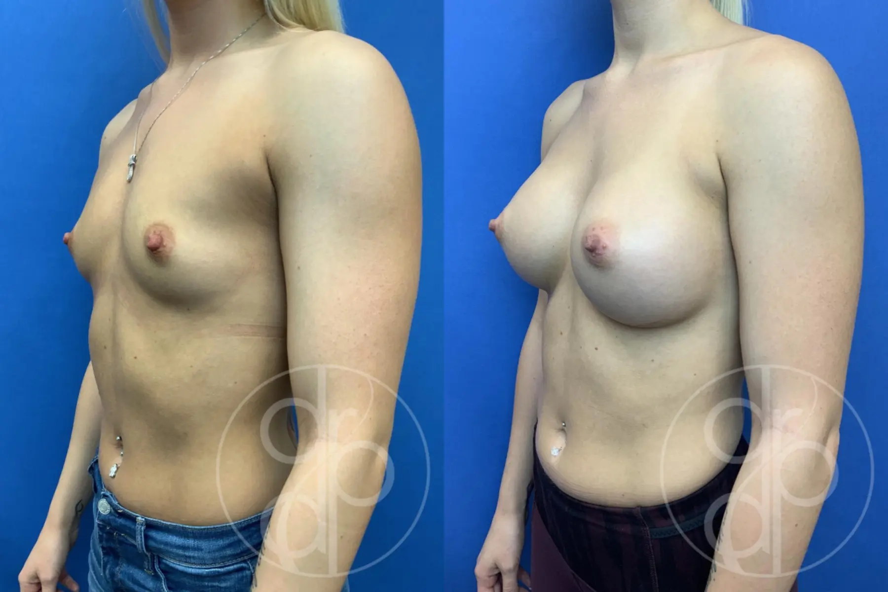 patient 10726 breast augmentation before and after result - Before and After 3