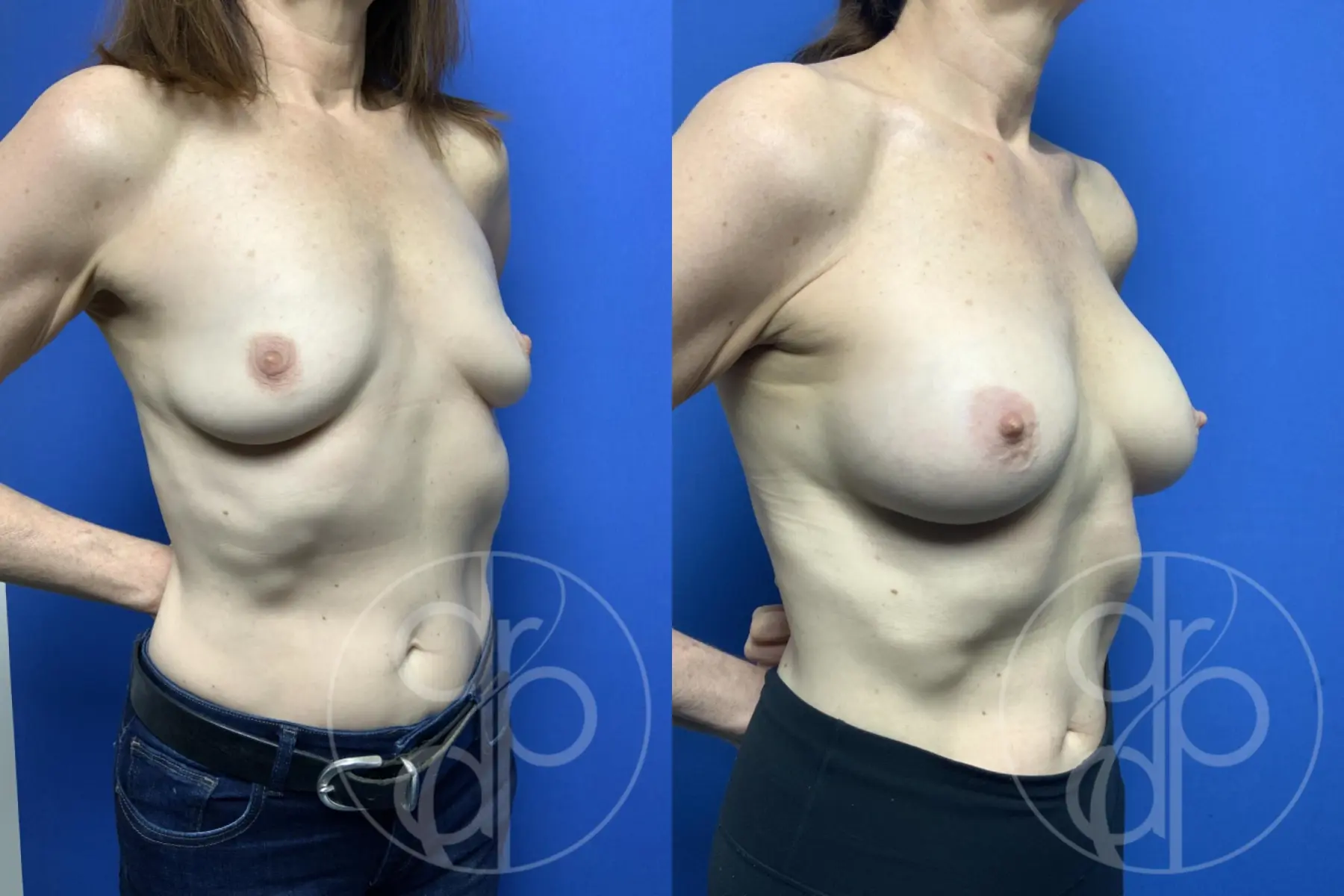 patient 11959 breast augmentation before and after result - Before and After 2