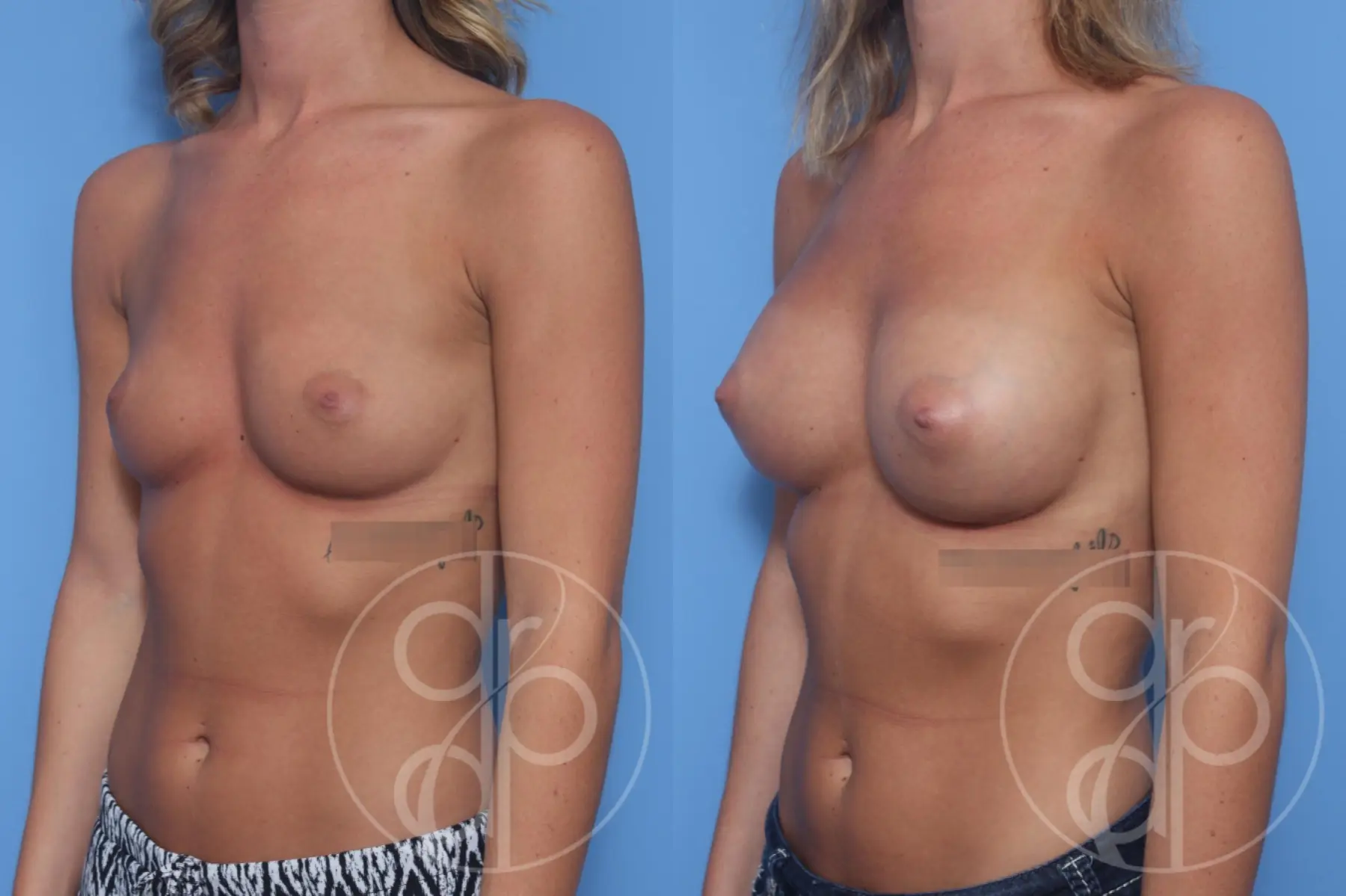patient 12931 breast augmentation before and after result - Before and After 3