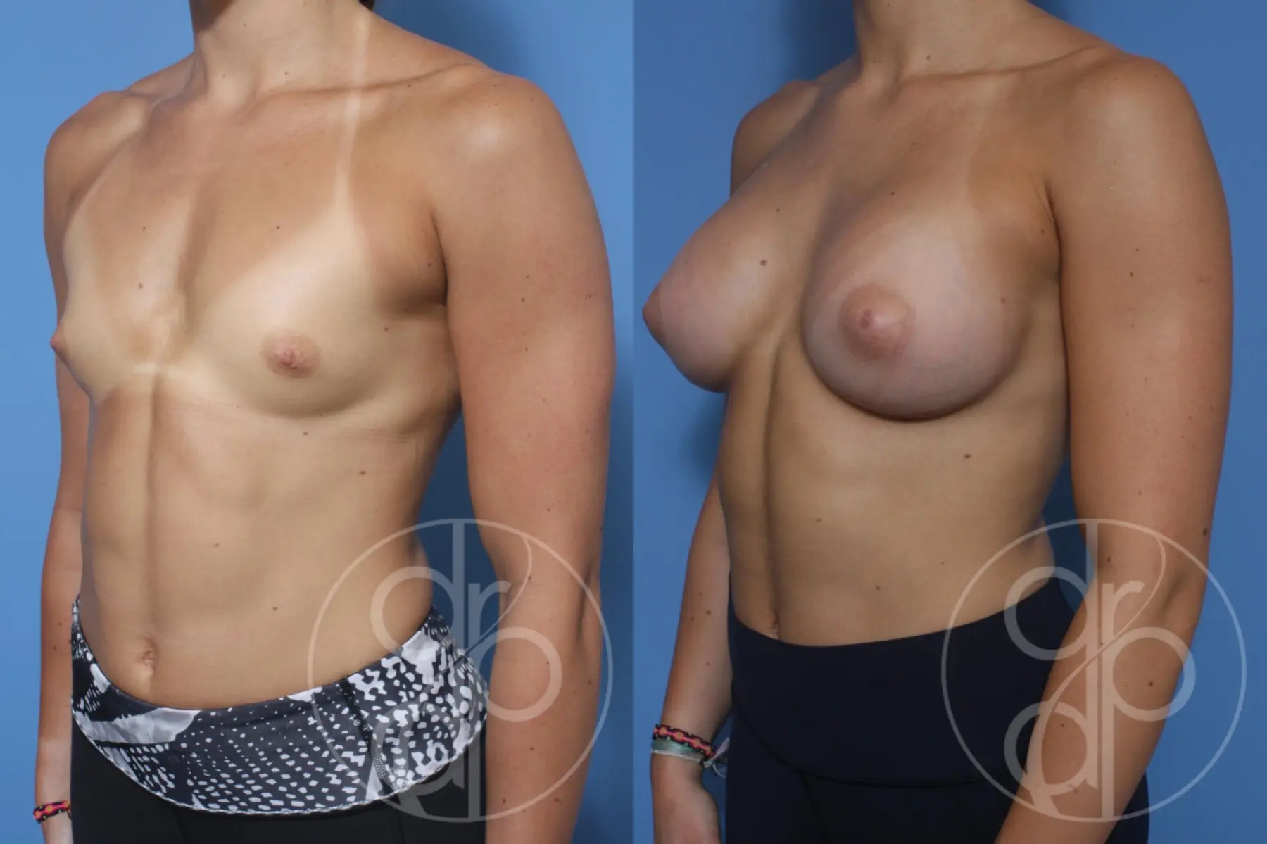 patient 12251 breast augmentation before and after result - Before and After 3