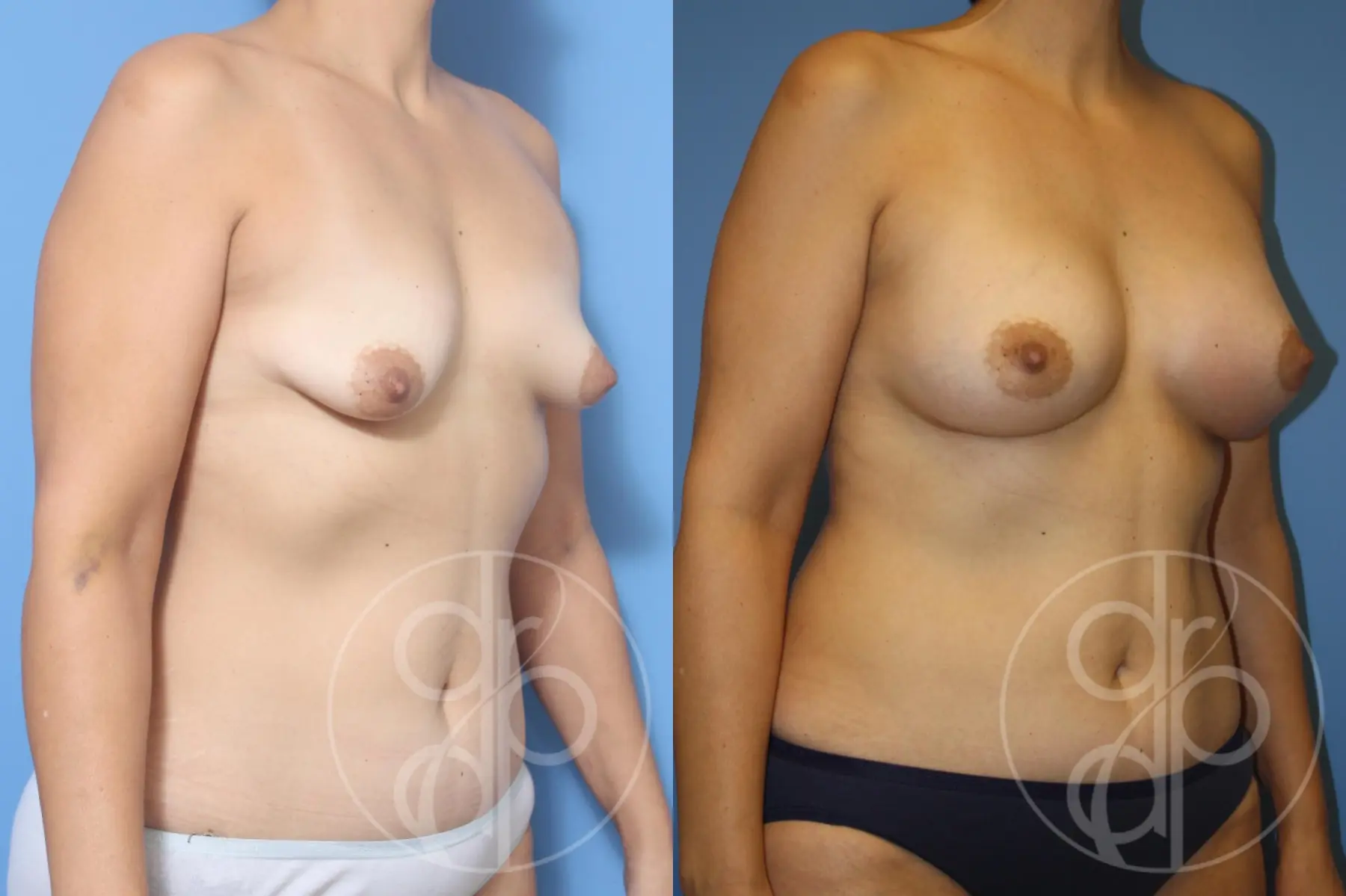 patient 12812 breast augmentation before and after result - Before and After 3