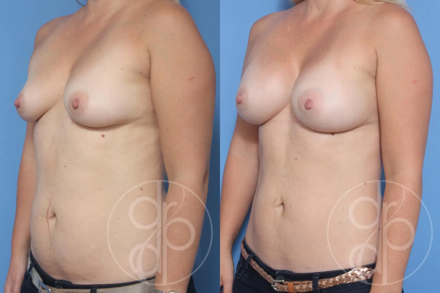 patient 12885 breast augmentation before and after result - Before and After 3