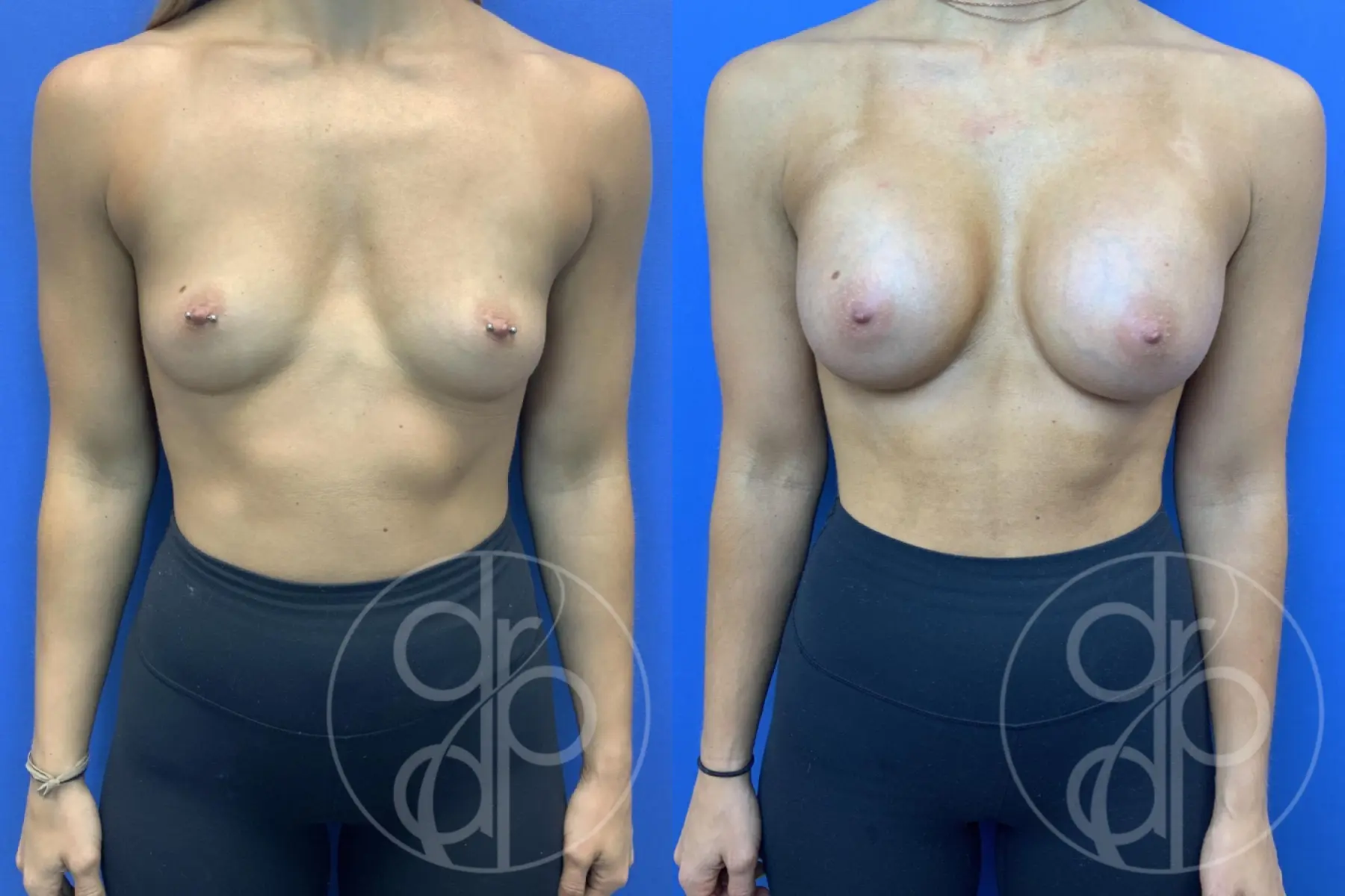 patient 10795 breast augmentation before and after result - Before and After 1