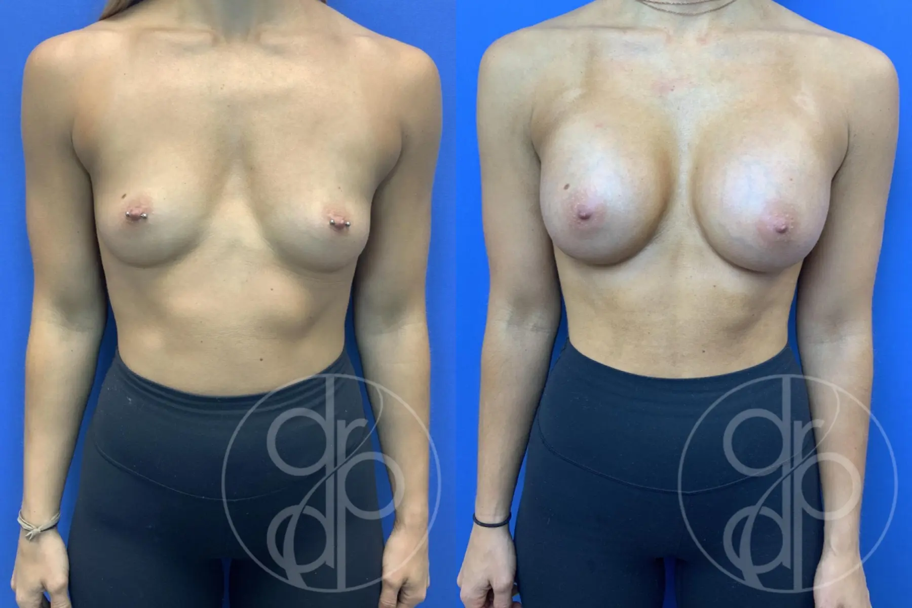 patient 10795 breast augmentation before and after result - Before and After