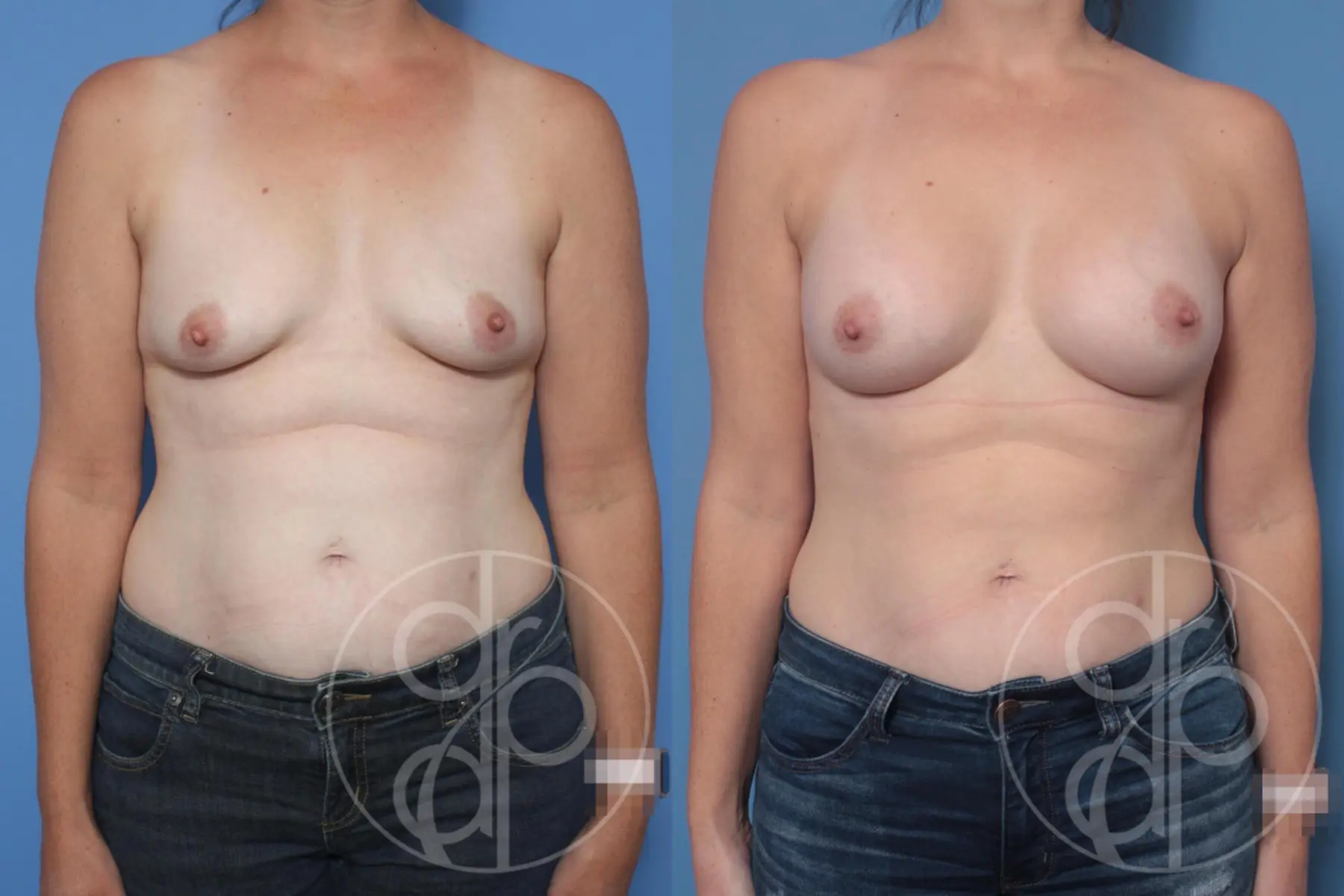 Breast Augmentation: Patient 91 - Before and After 1