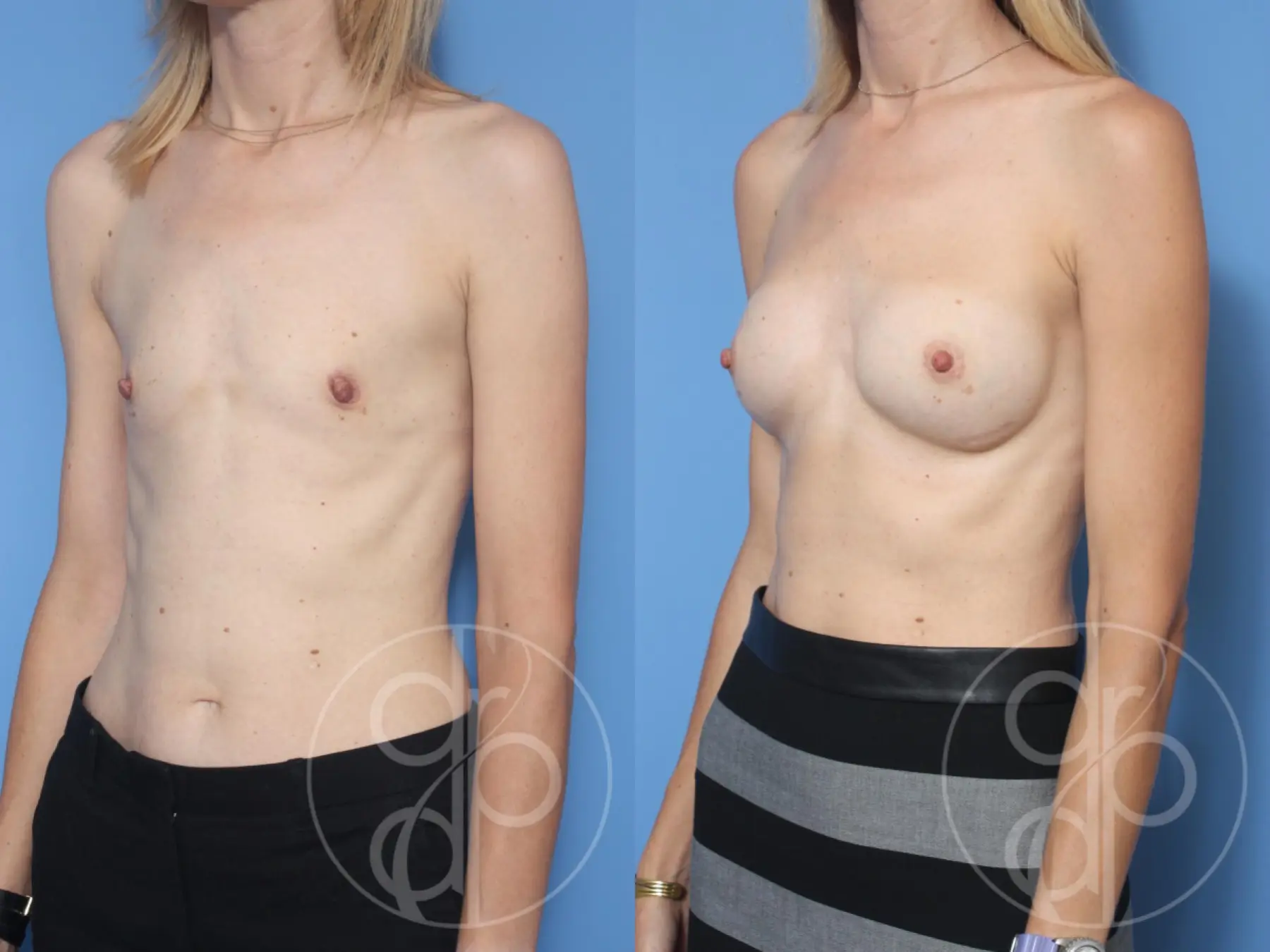 patient 13422 breast augmentation before and after result - Before and After 3