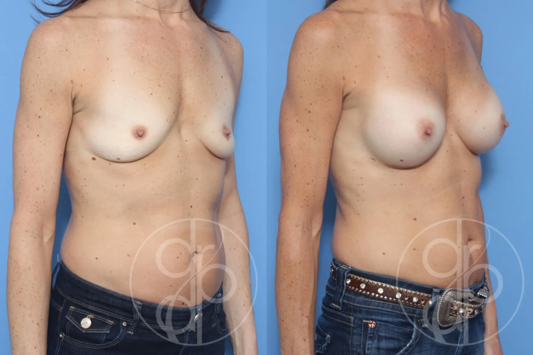 patient 10383 breast augmentation before and after result - Before and After 2
