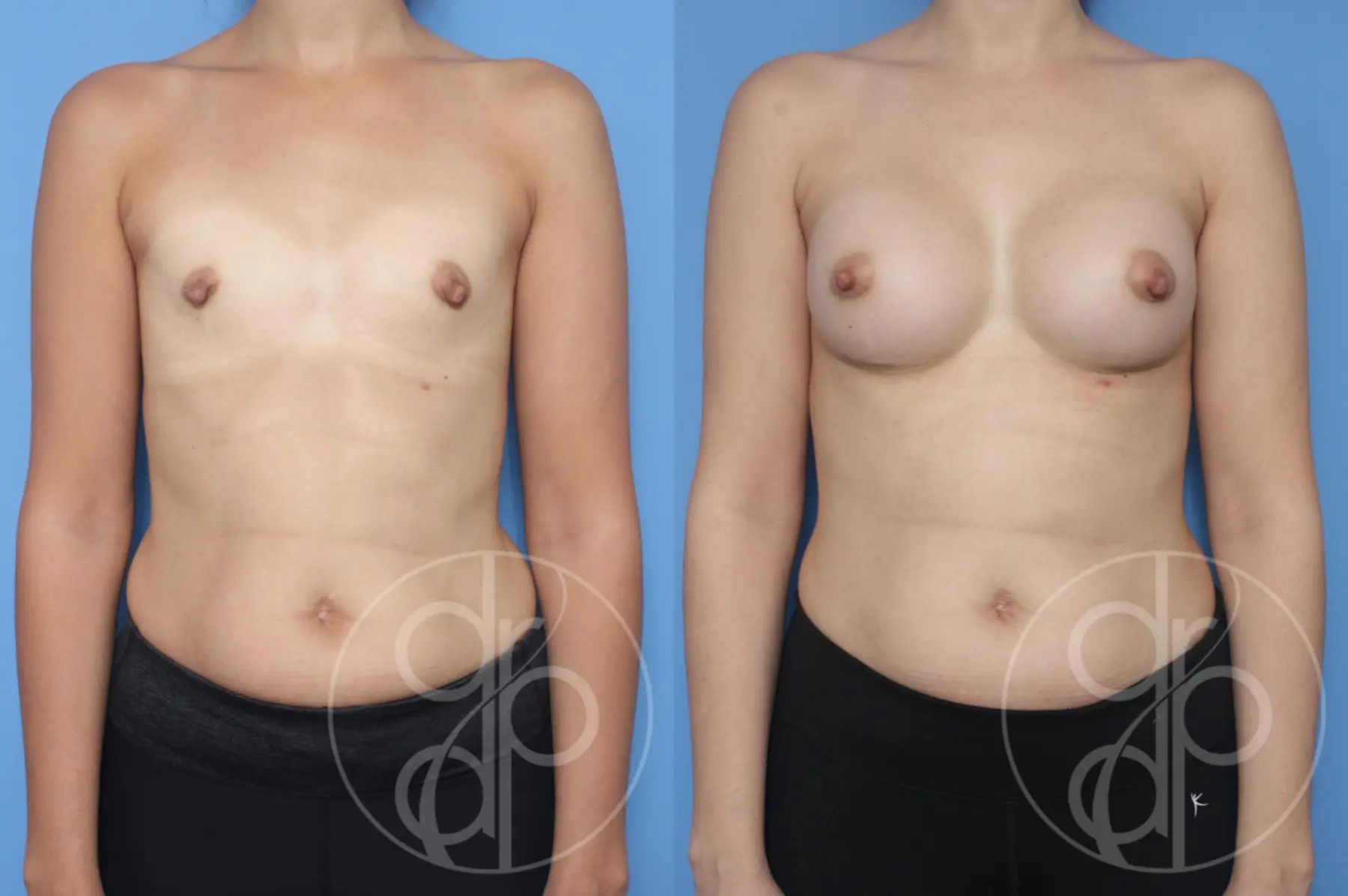 patient 12869 breast augmentation before and after result - Before and After 1