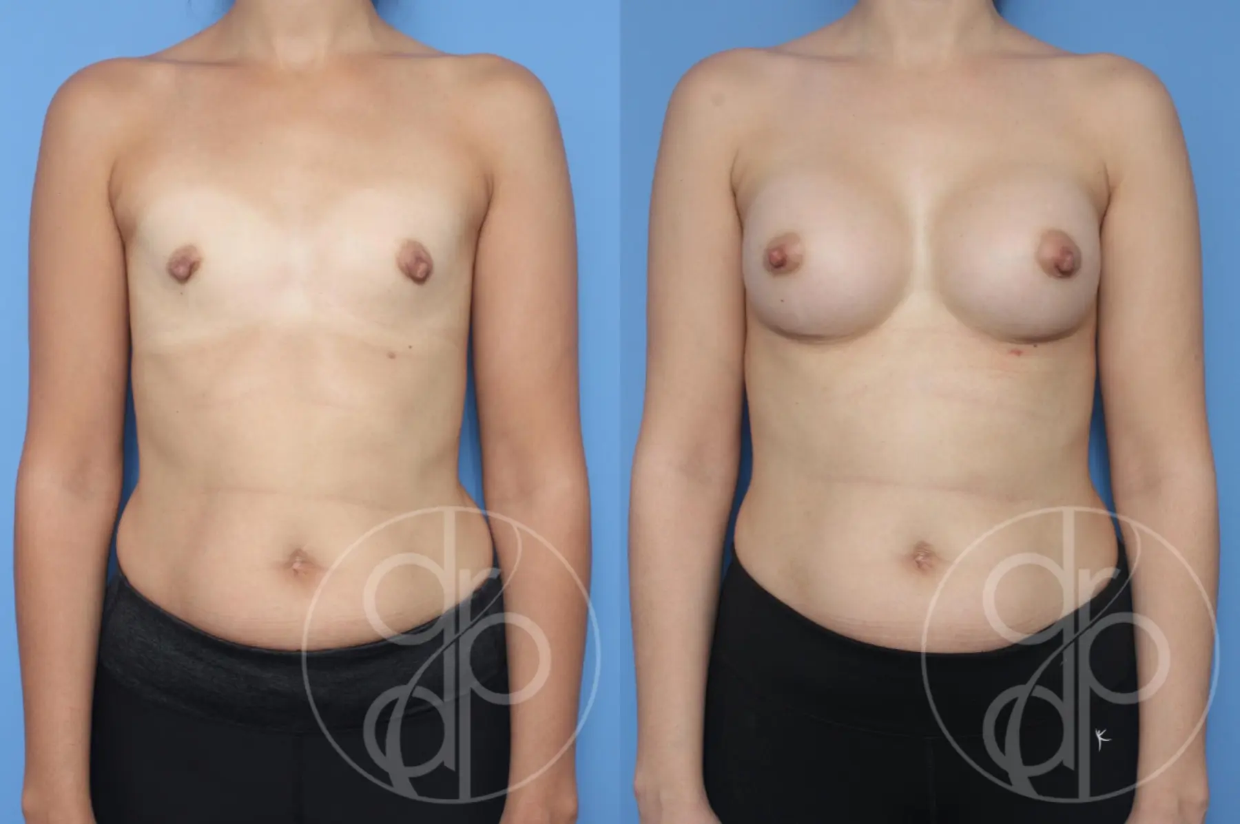 patient 12869 breast augmentation before and after result - Before and After