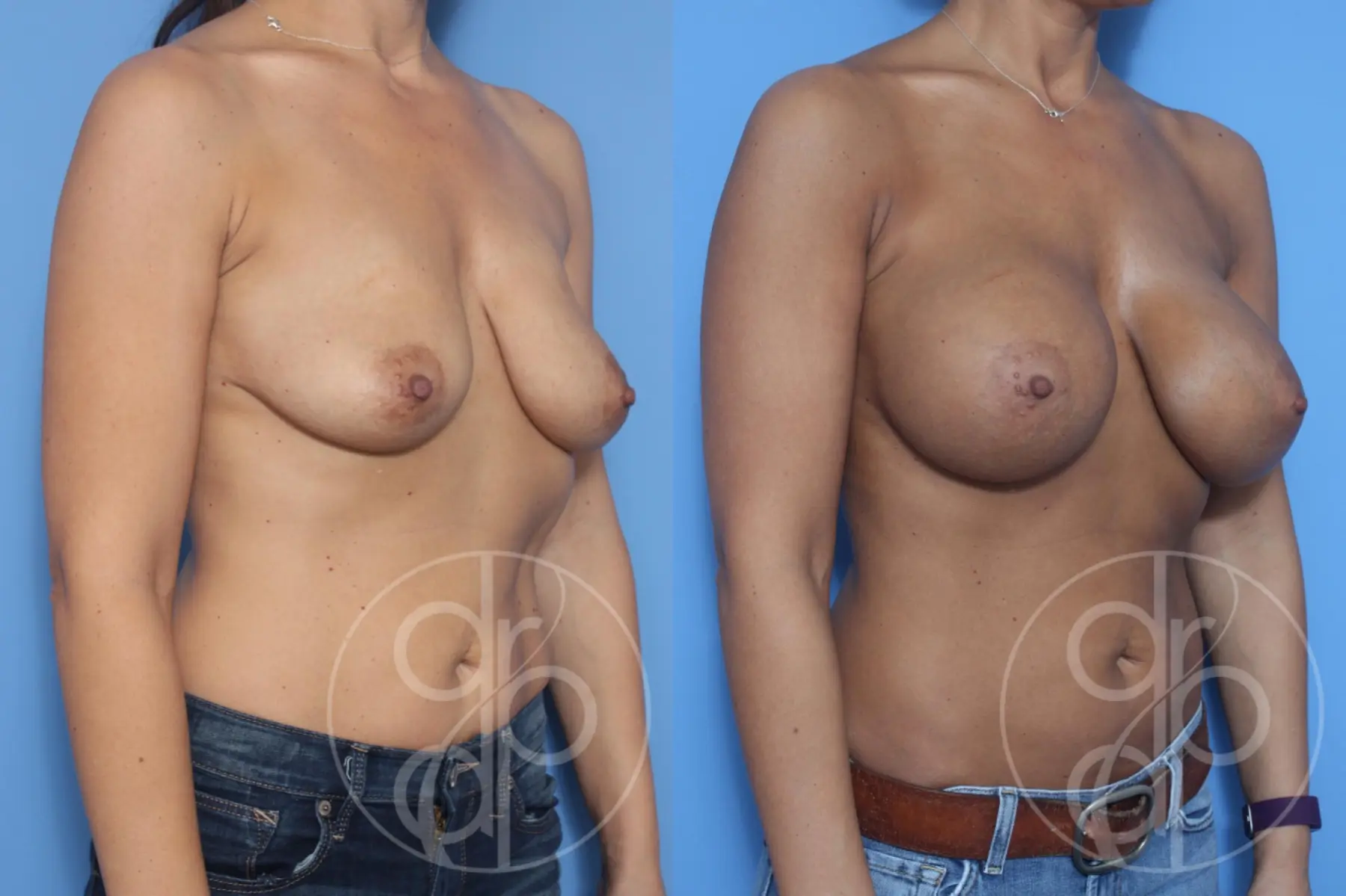 patient 10297 breast augmentation before and after result - Before and After 2