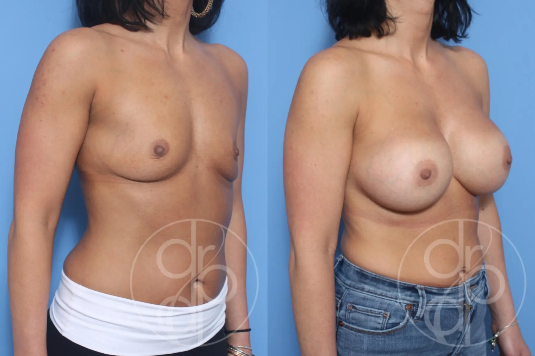 patient 12298 breast augmentation before and after result - Before and After 3