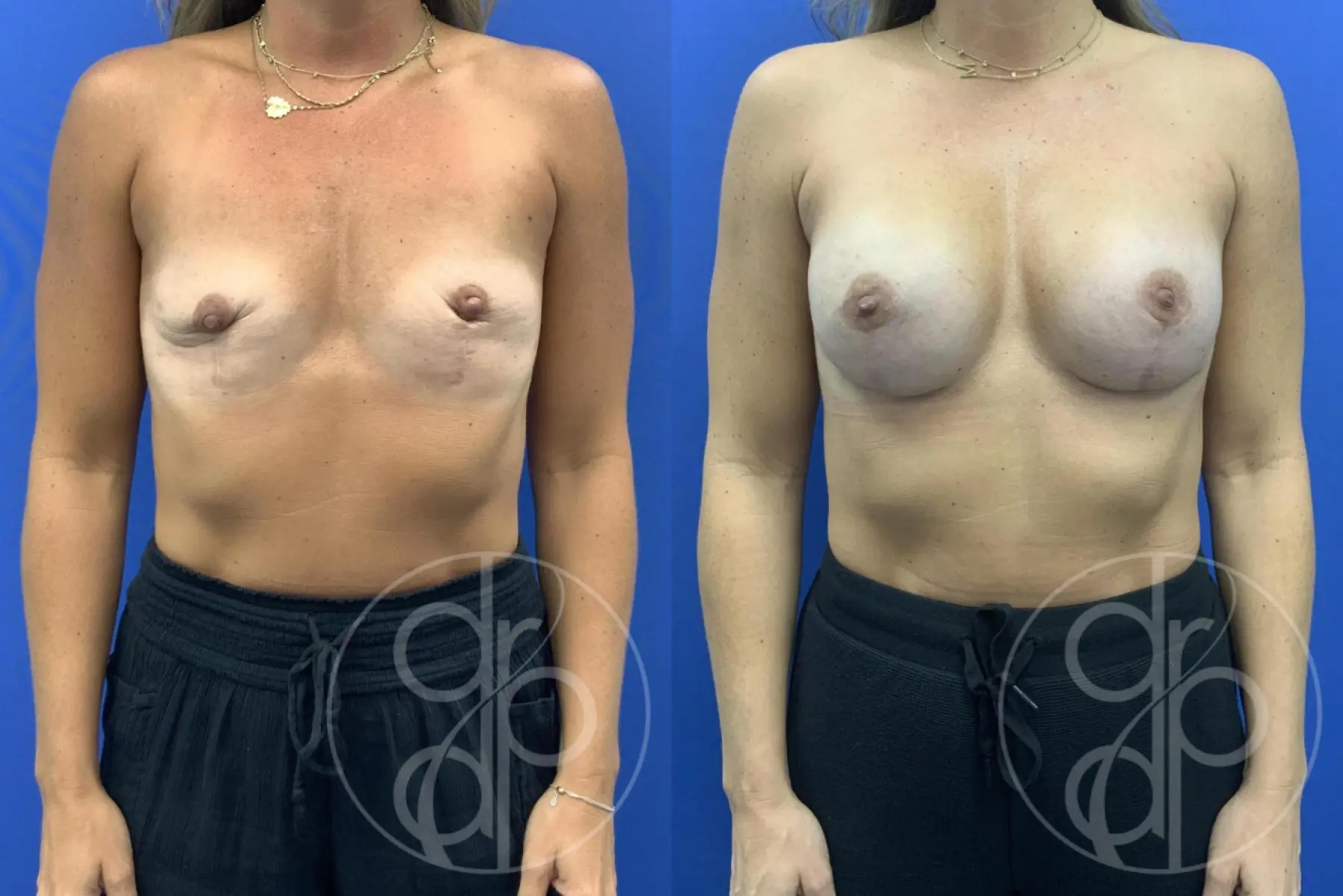 Breast Augmentation: Patient 4 - Before and After  