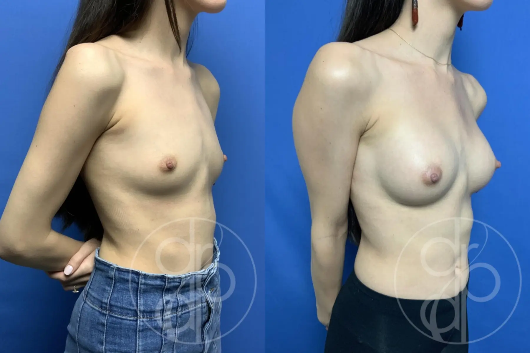 patient 13542 breast augmentation before and after result - Before and After 2