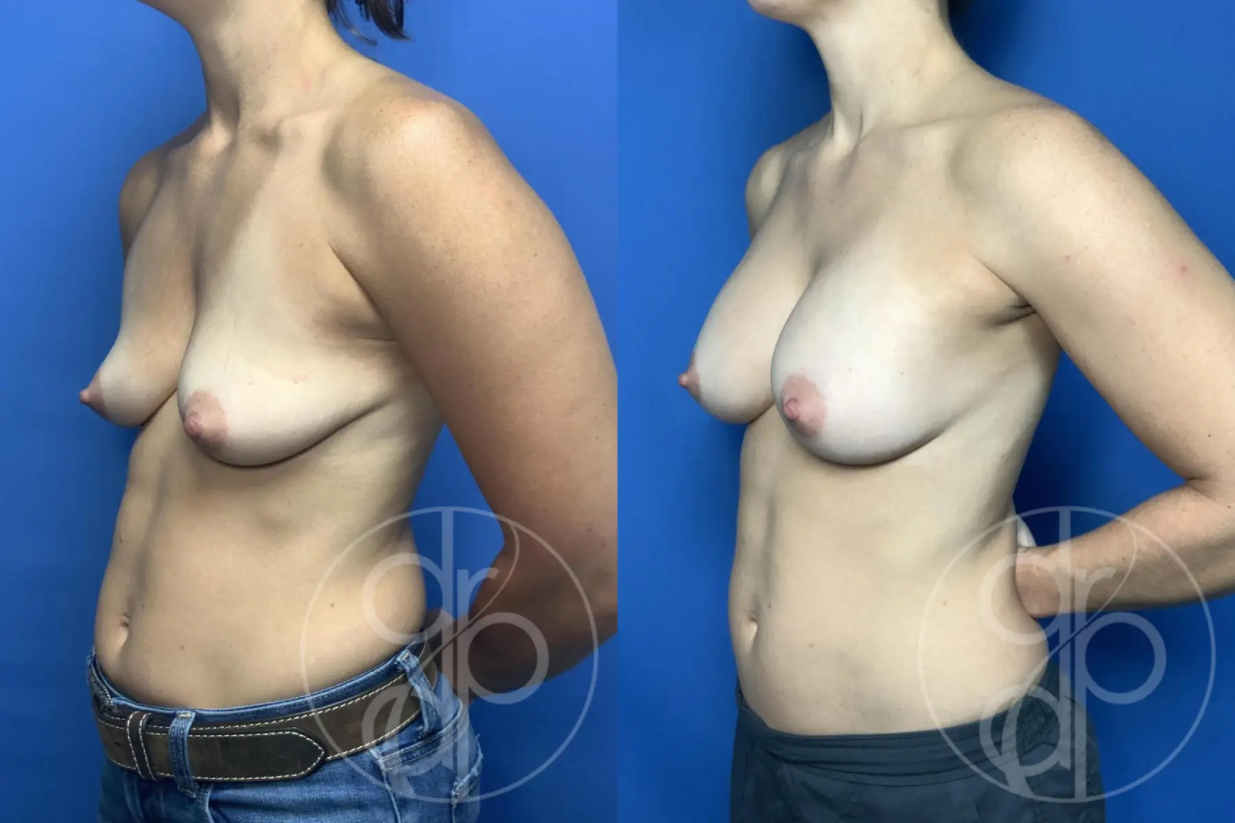 Breast Augmentation: Patient 93 - Before and After 3