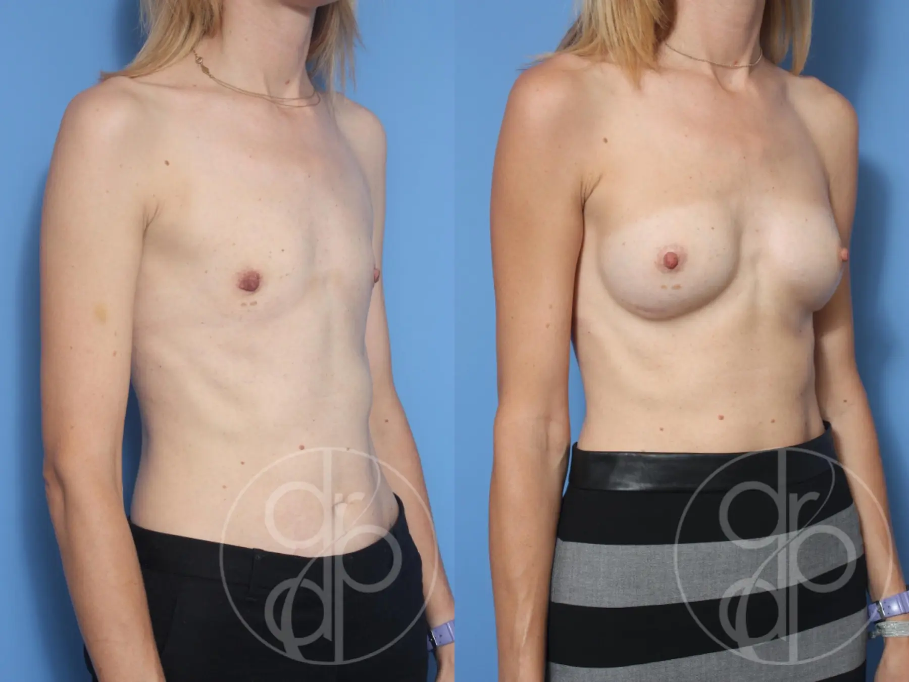 patient 13422 breast augmentation before and after result - Before and After 2