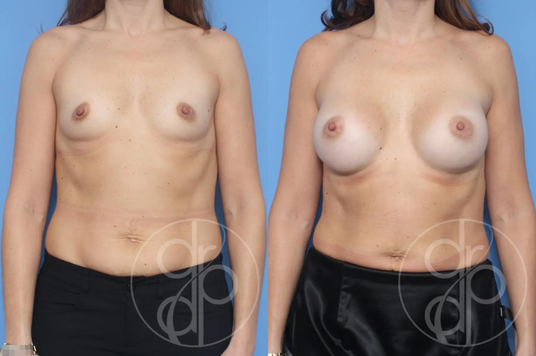 patient 13259 breast augmentation before and after result - Before and After