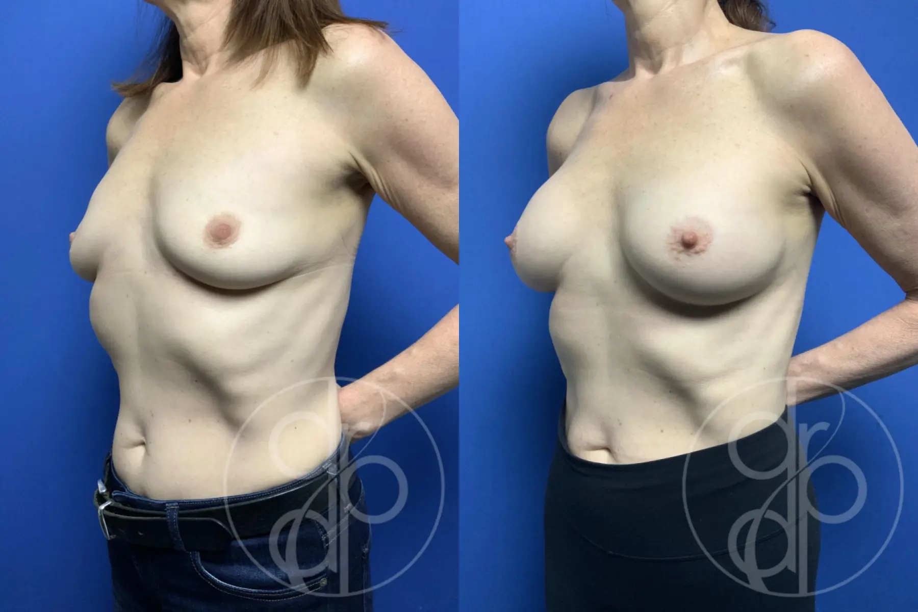 patient 11959 breast augmentation before and after result - Before and After 3