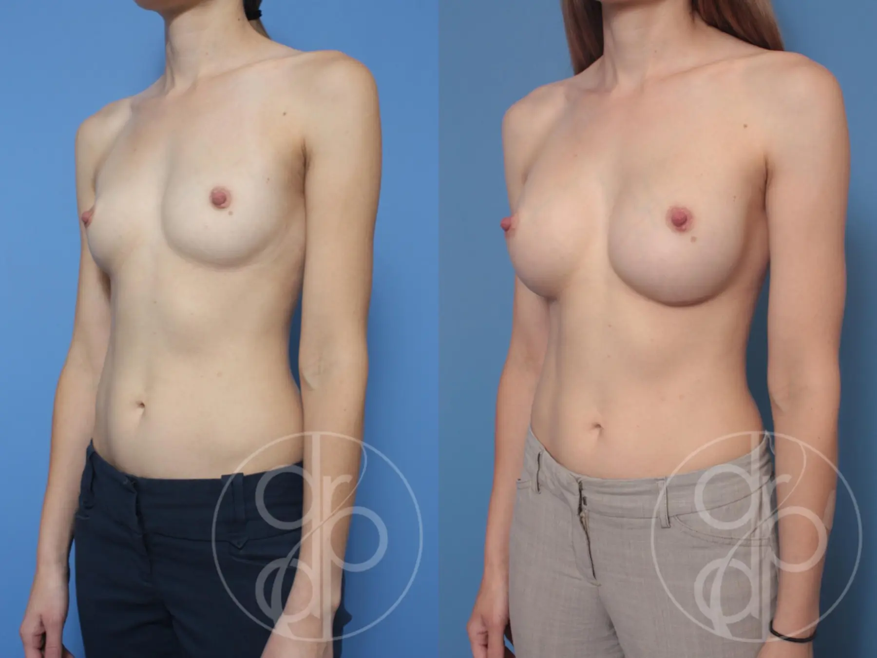 patient 10433 breast augmentation before and after result - Before and After 3