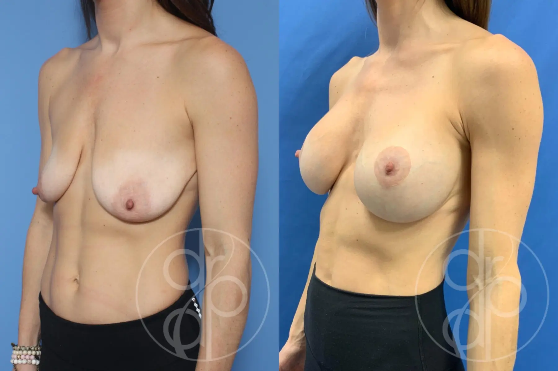 patient 10306 breast augmentation with lift before and after result - Before and After 3