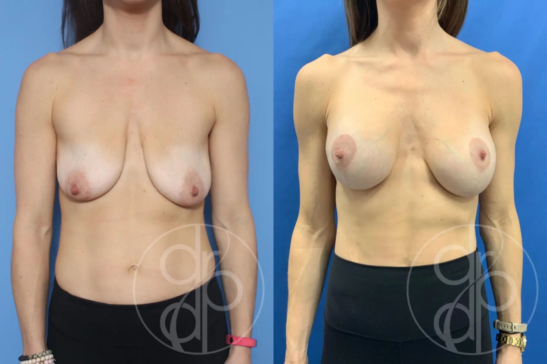 Breast Augmentation With Lift: Patient 4 - Before and After  