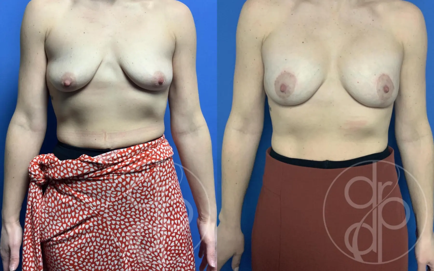 Breast Augmentation With Lift: Patient 2 - Before and After  