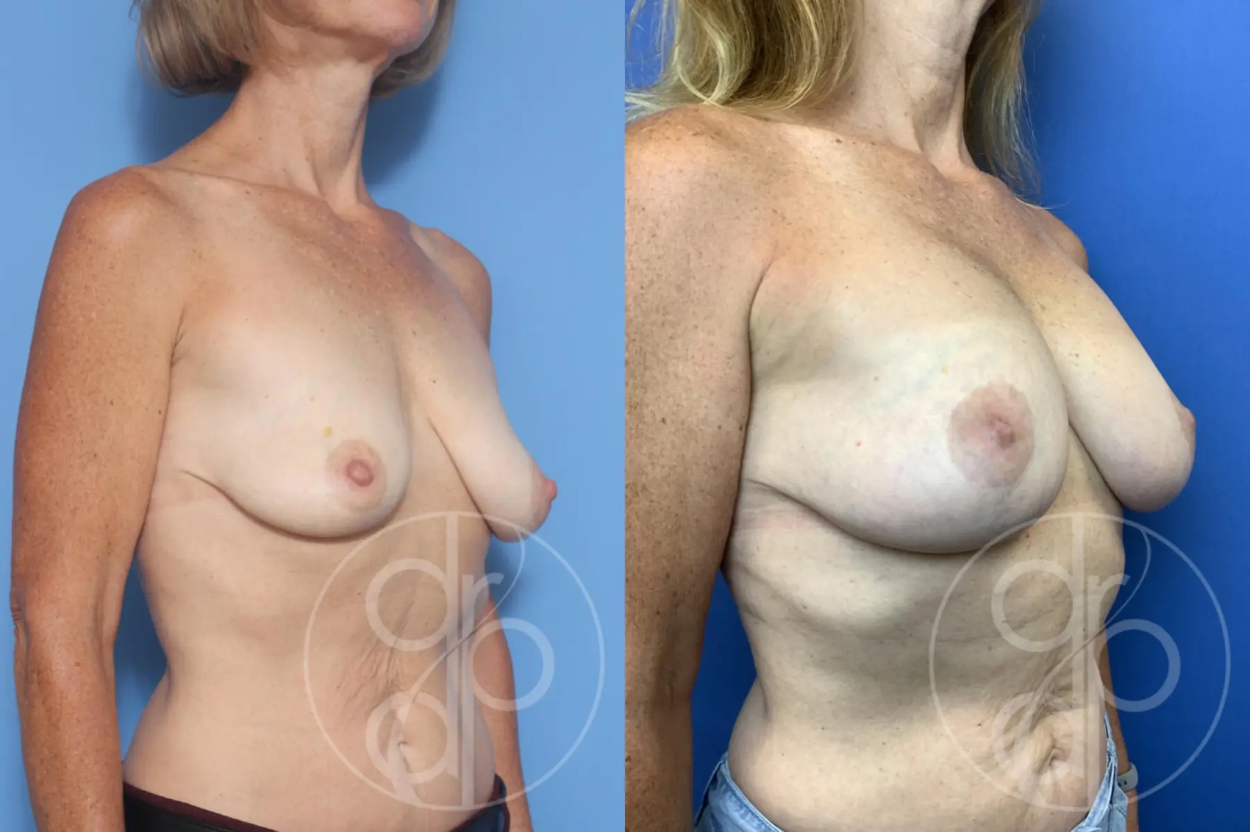 patient 12854 breast augmentation with lift before and after result - Before and After 3