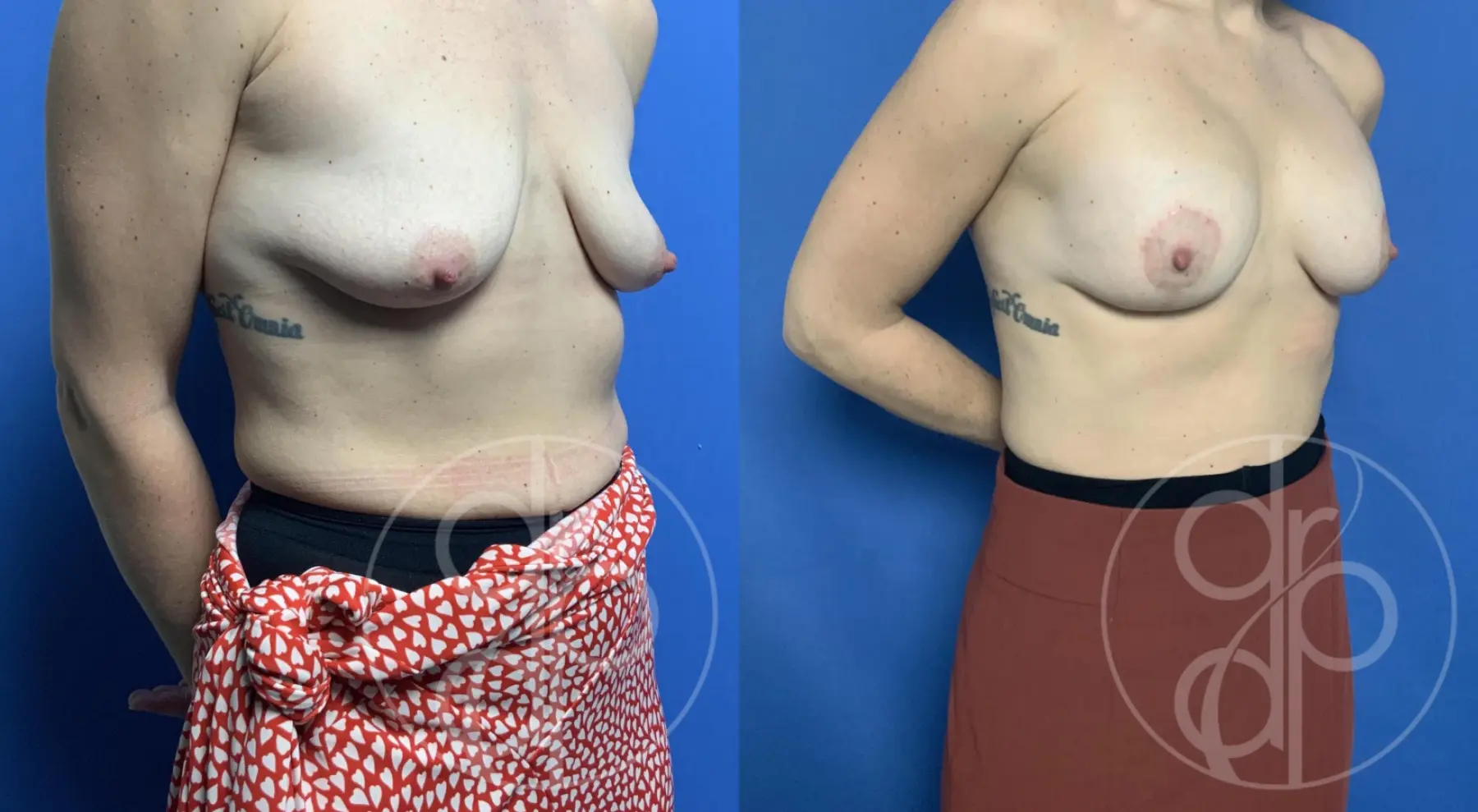 patient 12423 breast augmentation with lift before and after result - Before and After 2