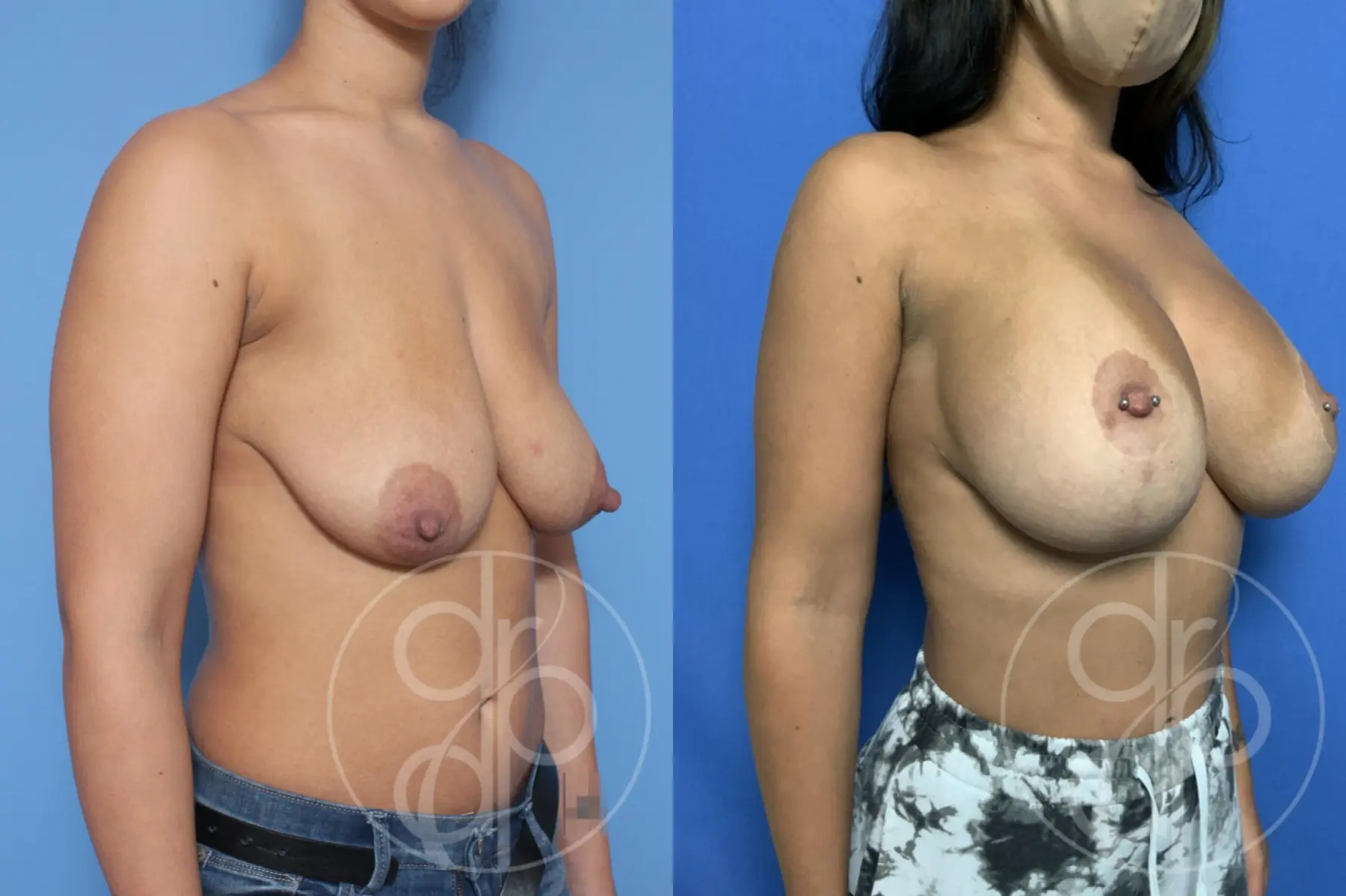 patient 10482 breast augmentation with lift before and after result - Before and After 3