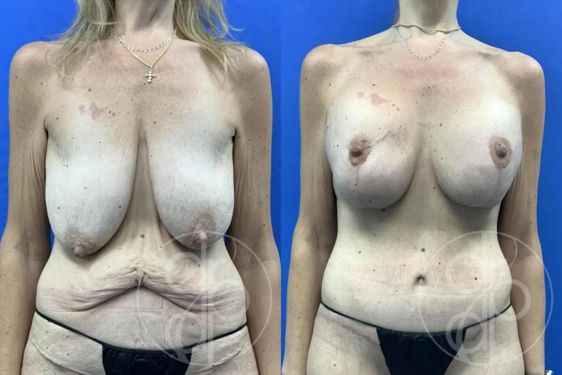 Breast Augmentation With Lift: Patient 1 - Before and After  