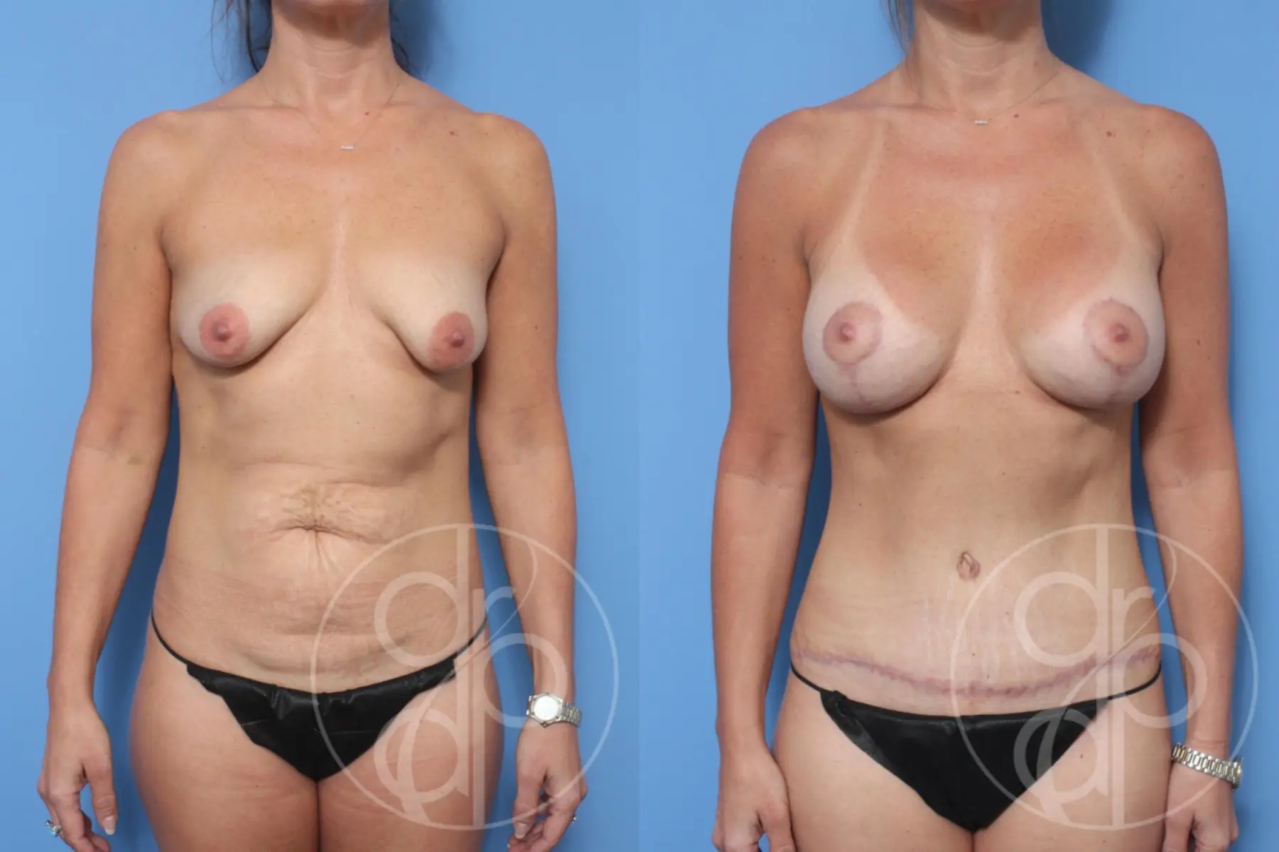 patient 10280 mommy makeover before and after result - Before and After