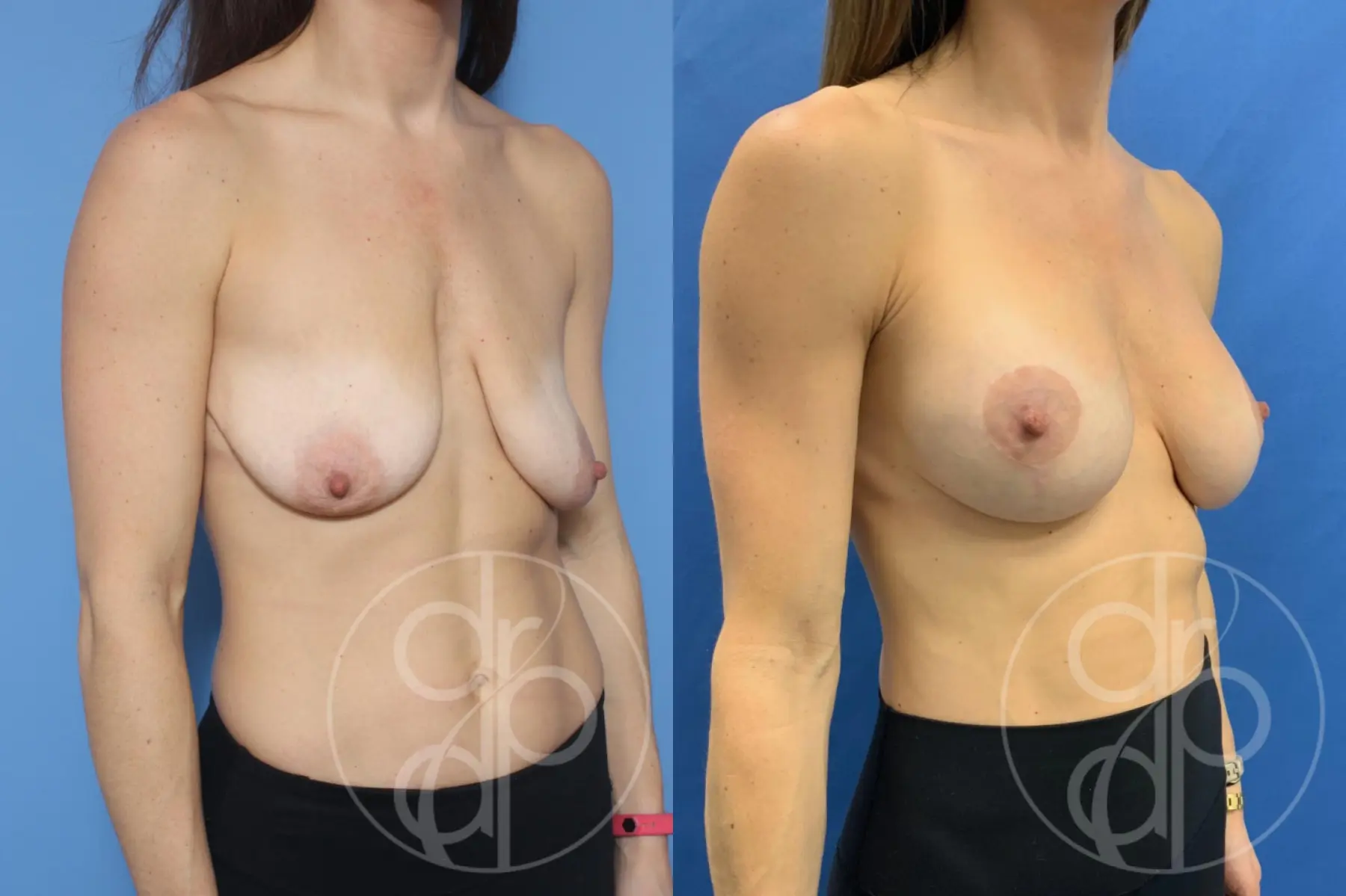 patient 10306 breast augmentation with lift before and after result - Before and After 2