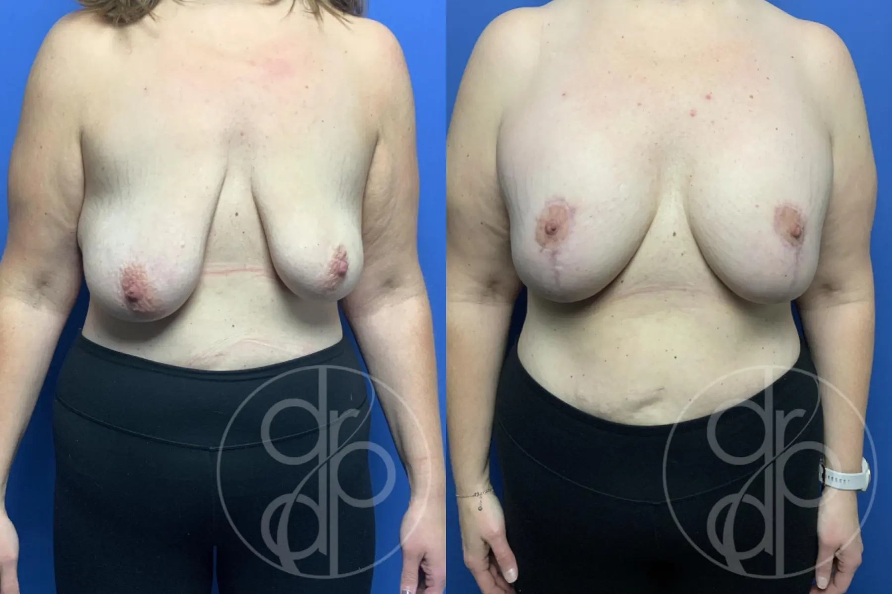 patient 12646 breast augmentation with lift before and after result - Before and After