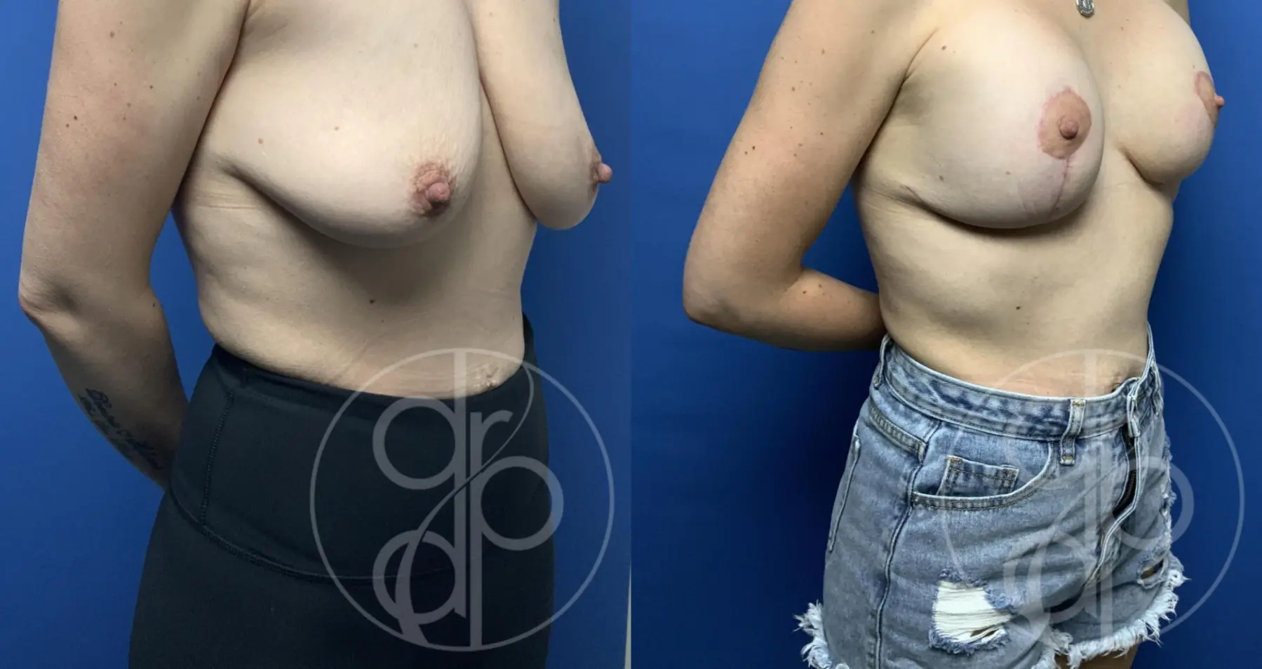 patient 13432 breast augmentation with lift before and after result - Before and After 3