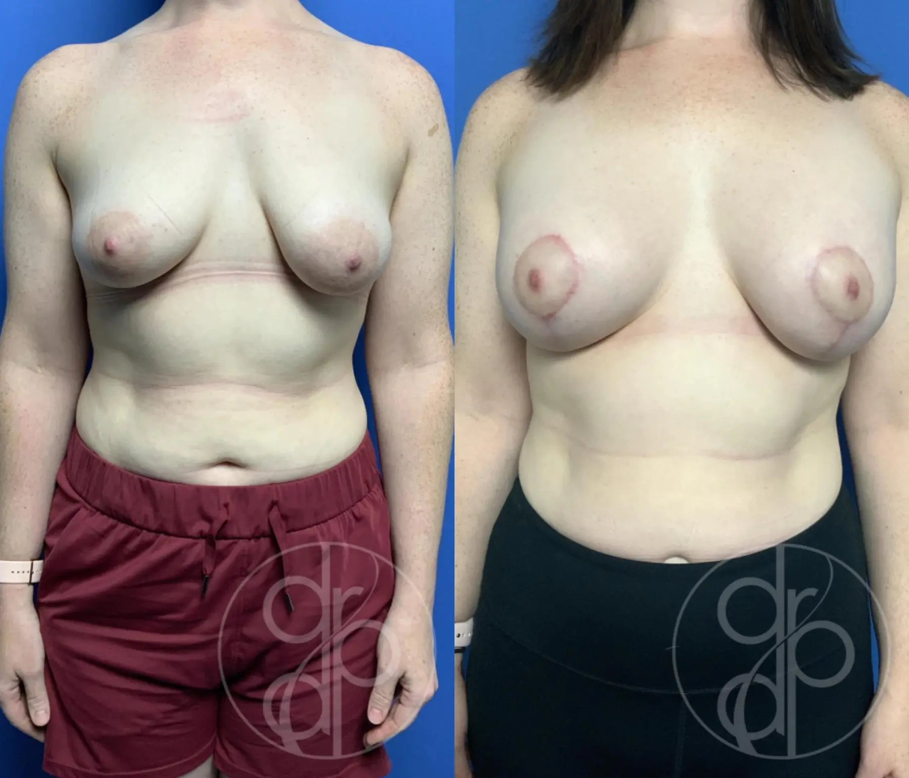 patient 12535 breast augmentation with lift before and after result - Before and After 1