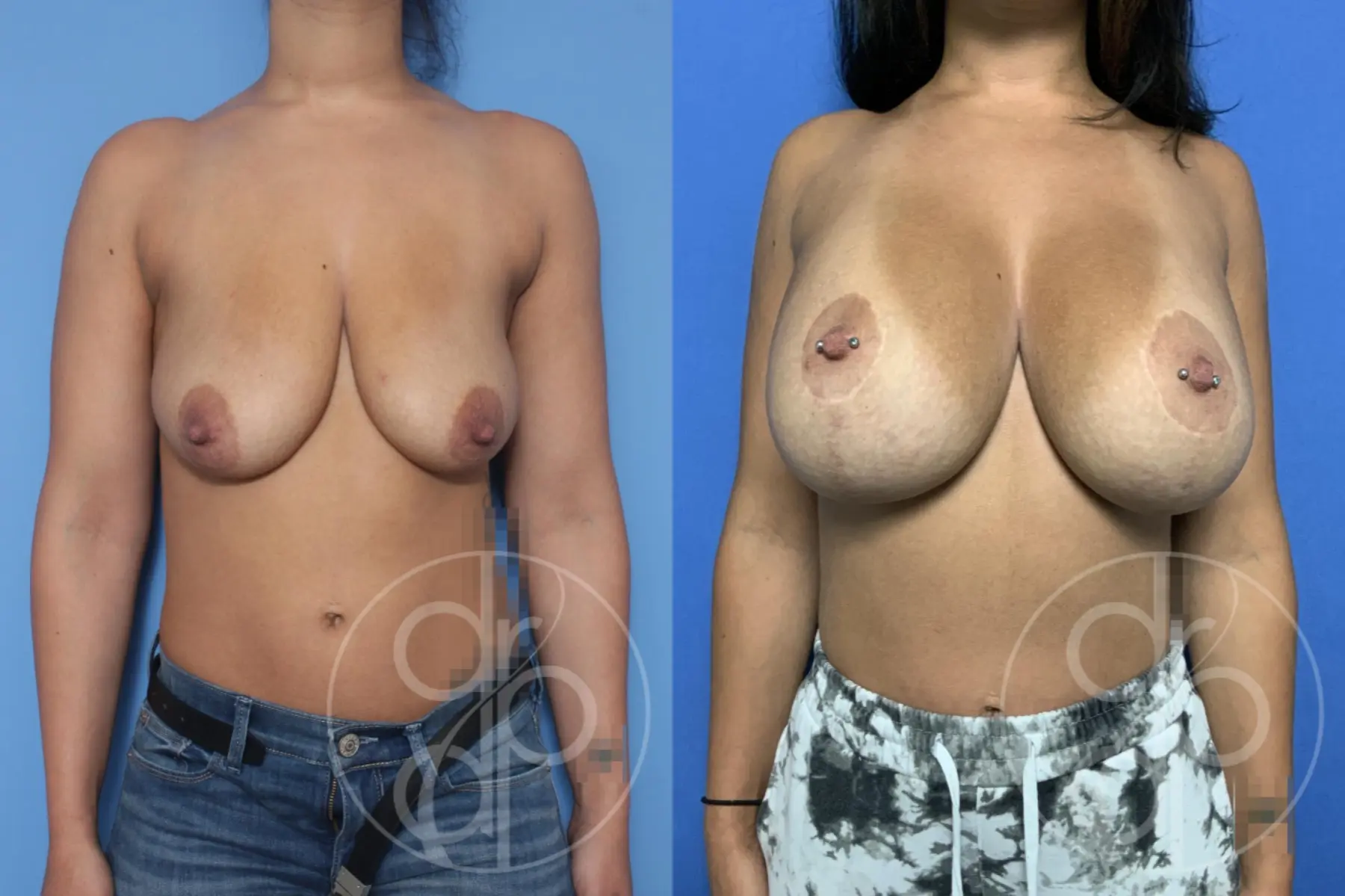 patient 10482 breast augmentation with lift before and after result - Before and After