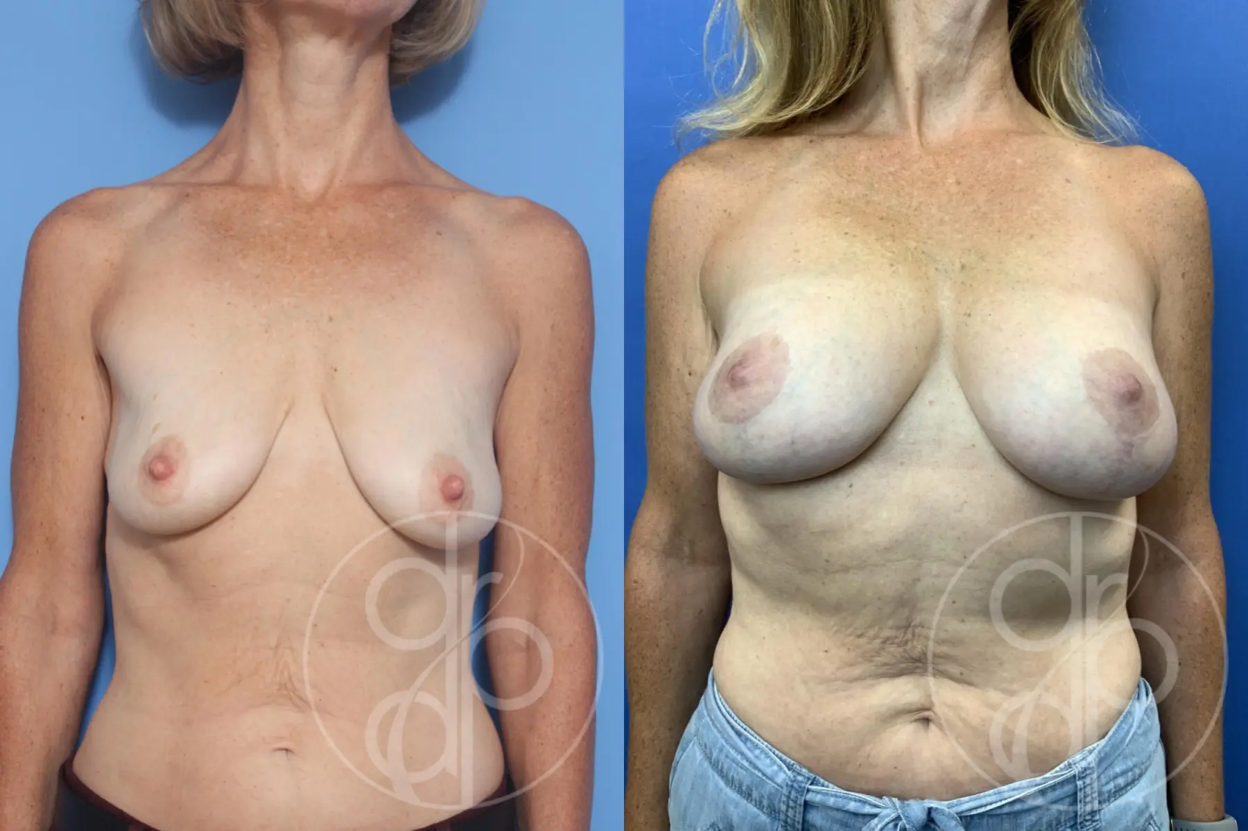 patient 12854 breast augmentation with lift before and after result - Before and After 1