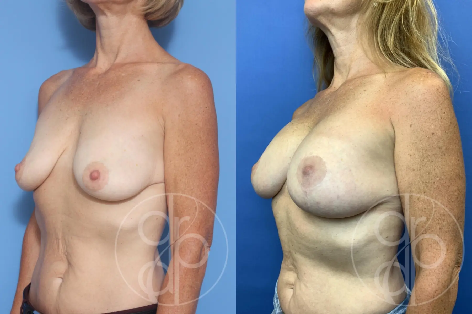 patient 12854 breast augmentation with lift before and after result - Before and After 2
