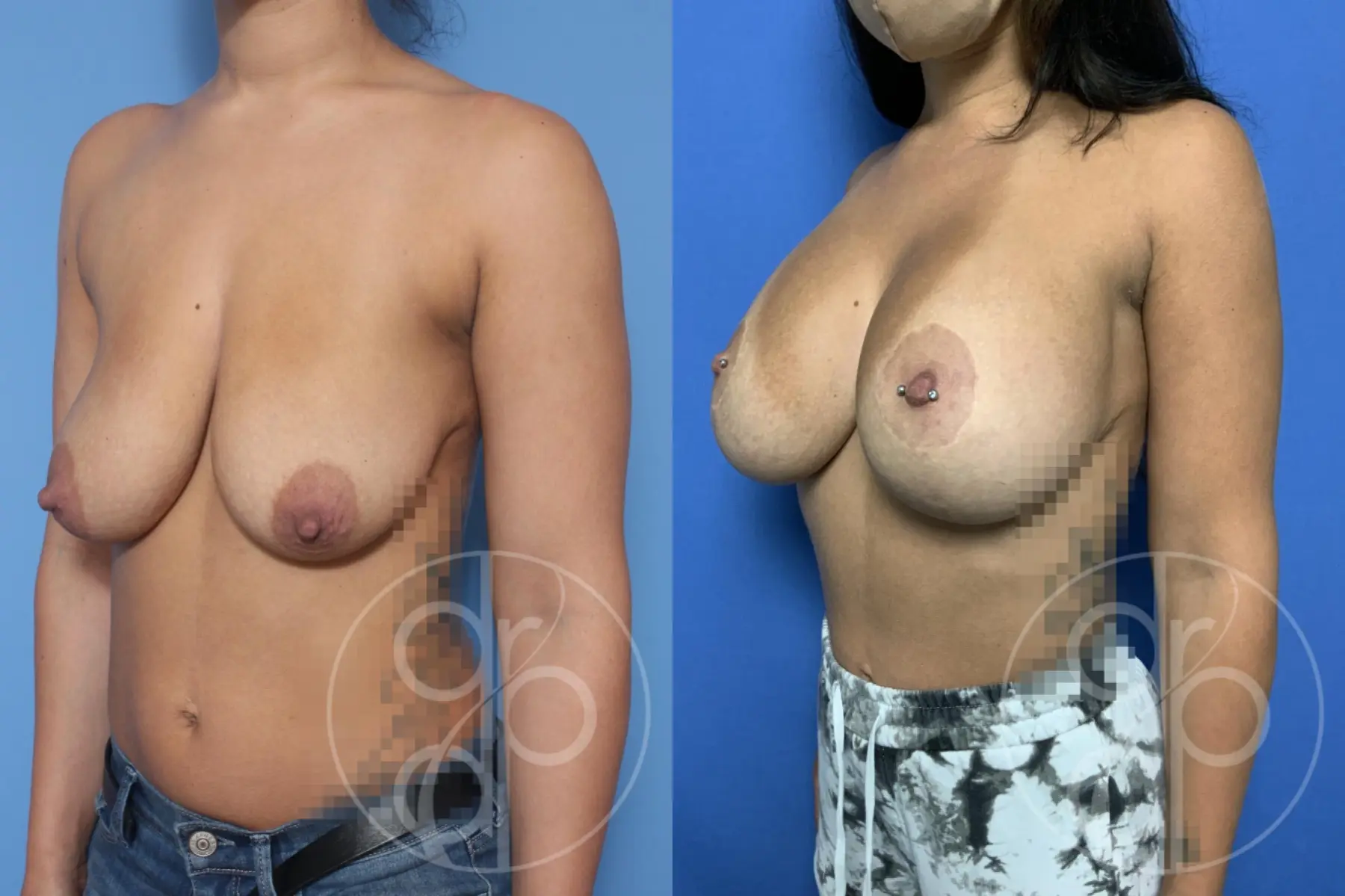 patient 10482 breast augmentation with lift before and after result - Before and After 2