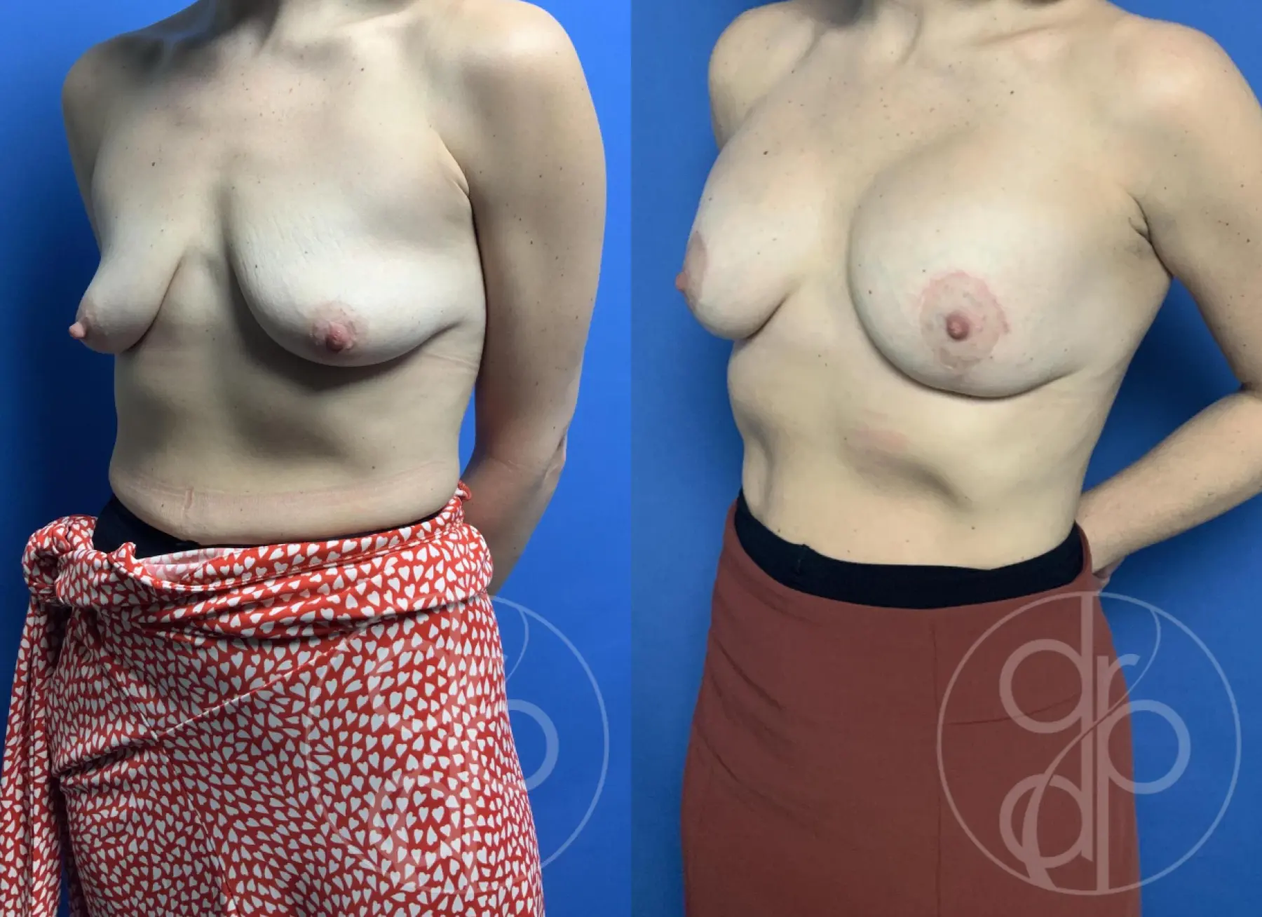 patient 12423 breast augmentation with lift before and after result - Before and After 3