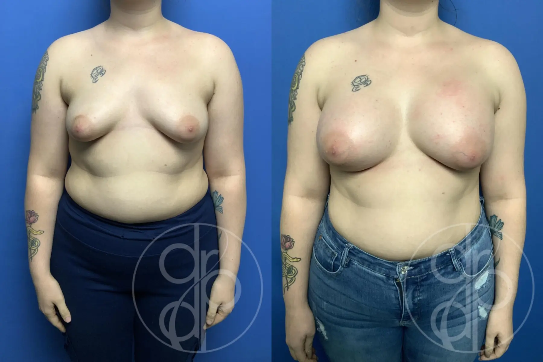 patient 13547 breast augmentation before and after result - Before and After