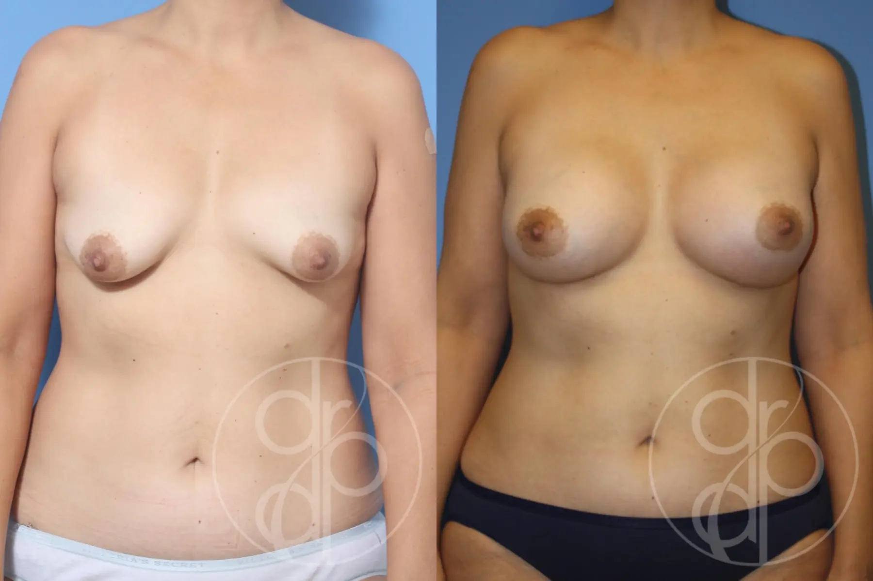 patient 12812 breast augmentation before and after result - Before and After