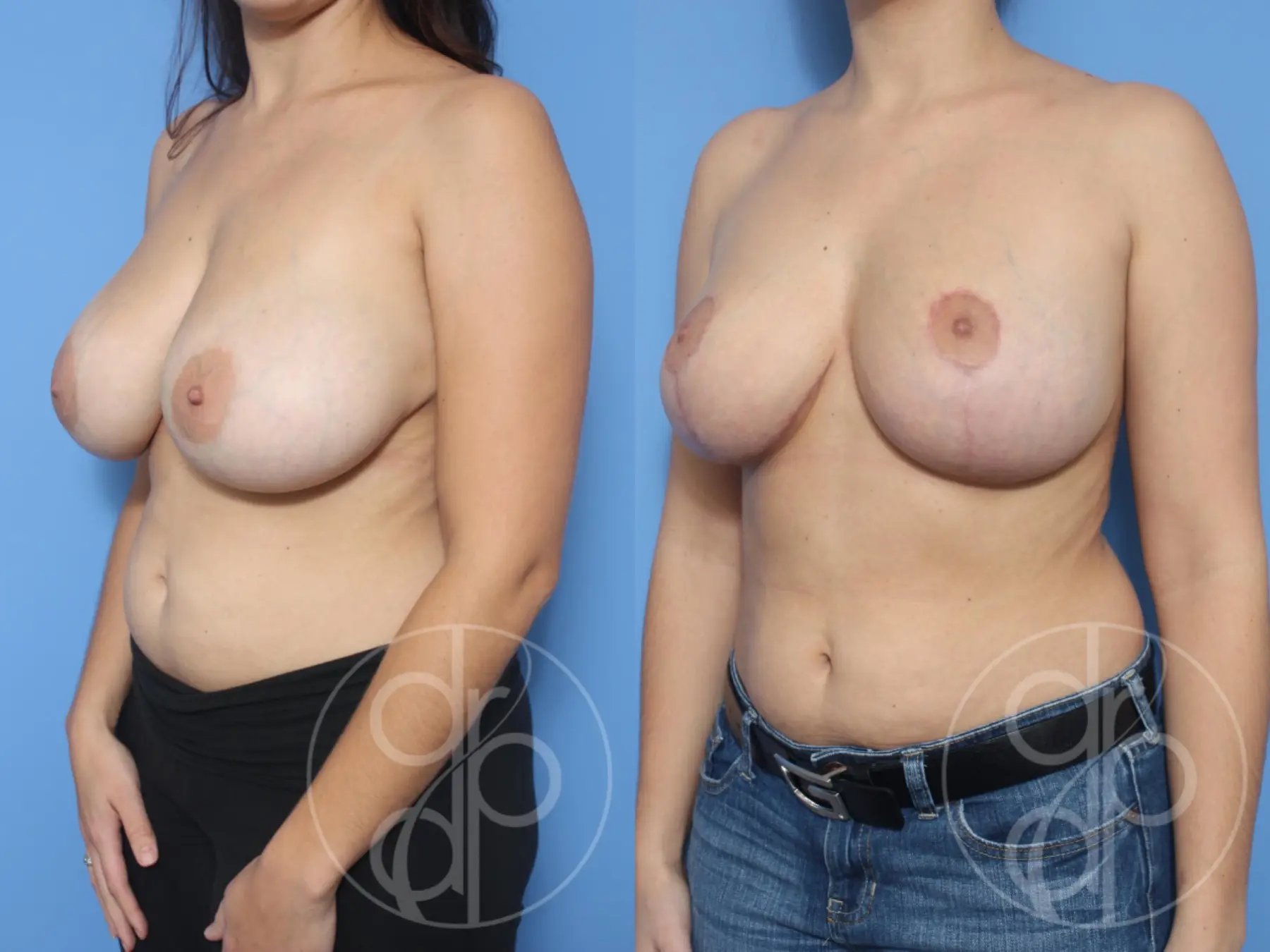 patient 13160 breast implant removal with lift before and after result - Before and After 3