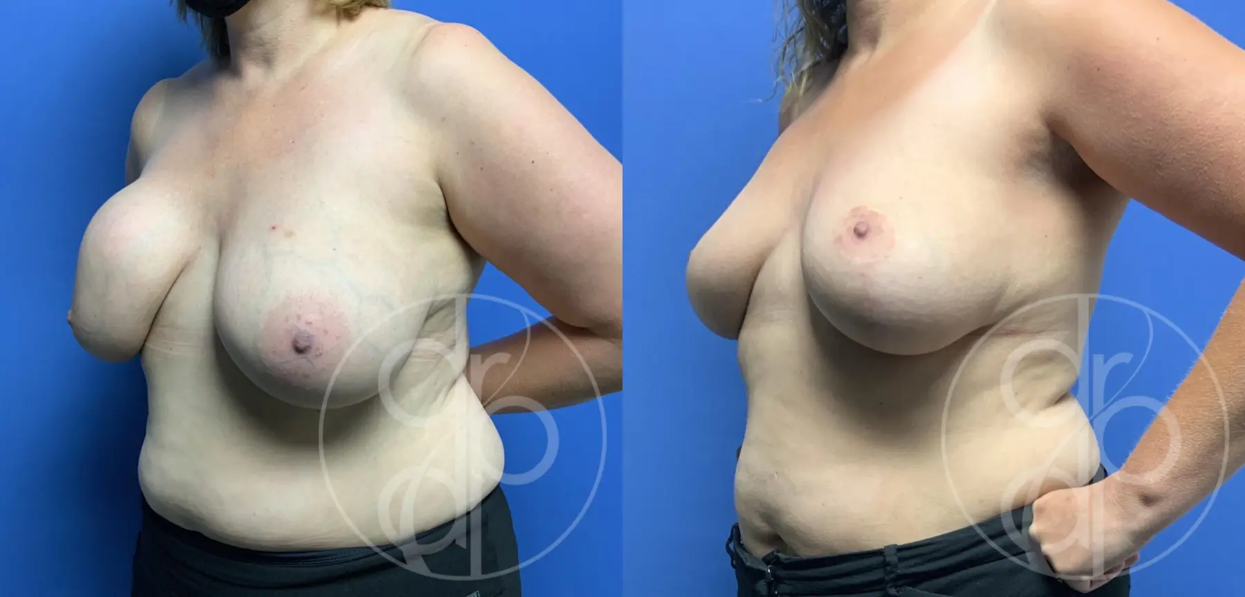 patient 12601 breast implant removal with lift before and after result - Before and After 3
