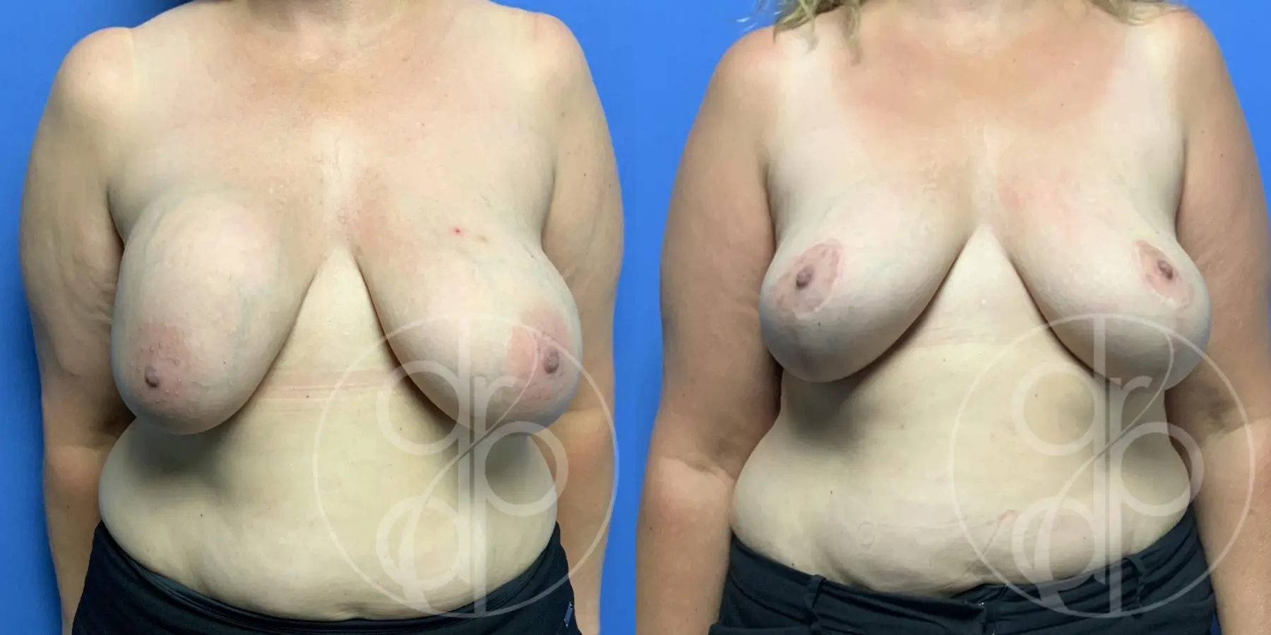 patient 12601 breast implant removal with lift before and after result - Before and After